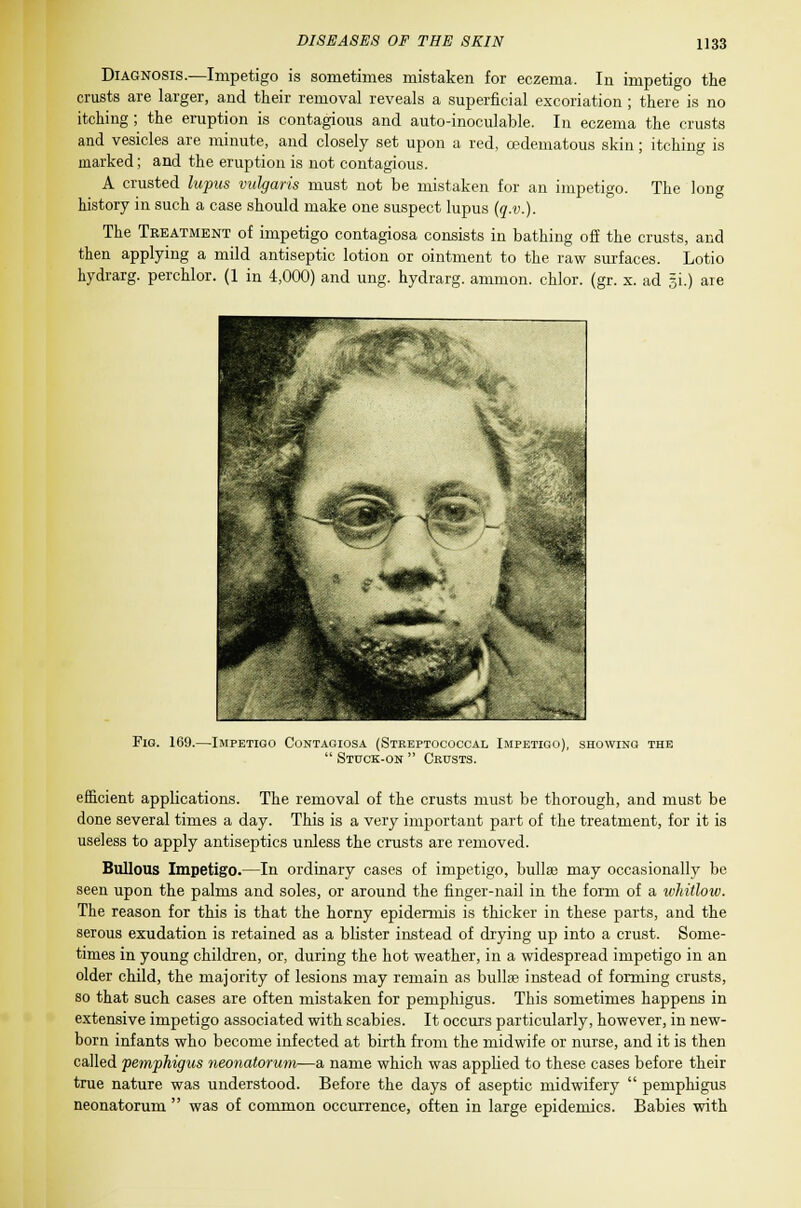 itching is Diagnosis.—Impetigo is sometimes mistaken for eczema. In impetigo the crusts are larger, and their removal reveals a superficial excoriation ; there is no itching; the eruption is contagious and auto-inoculable. In eczema the crusts and vesicles are minute, and closely set upon a red, cedematous skin marked; and the eruption is not contagious. A crusted lupus vulgaris must not be mistaken for an impetigo, history in such a case should make one suspect lupus (q.v.). The Treatment of impetigo contagiosa consists in bathing off the crusts, and then applying a mild antiseptic lotion or ointment to the raw surfaces. Lotio hydrarg. perchlor. (1 in 4,000) and ung. hydrarg. ammon. chlor. (gr. x. ad §i.) are The long Fig. 169.—Impetigo Contagiosa (Streptococcal Impetigo), showing the  Stuck-on  Cbusts. efficient applications. The removal of the crusts must be thorough, and must be done several times a day. This is a very important part of the treatment, for it is useless to apply antiseptics unless the crusts are removed. Bullous Impetigo.—In ordinary cases of impetigo, bullae may occasionally be seen upon the palms and soles, or around the finger-nail in the form of a whitlow. The reason for this is that the horny epidermis is thicker in these parts, and the serous exudation is retained as a blister instead of drying up into a crust. Some- times in young children, or, during the hot weather, in a widespread impetigo in an older child, the majority of lesions may remain as bullae instead of forming crusts, so that such cases are often mistaken for pemphigus. This sometimes happens in extensive impetigo associated with scabies. It occurs particularly, however, in new- born infants who become infected at birth from the midwife or nurse, and it is then called pemphigus neonatorum—a name which was applied to these cases before their true nature was understood. Before the days of aseptic midwifery  pemphigus neonatorum  was of common occurrence, often in large epidemics. Babies with