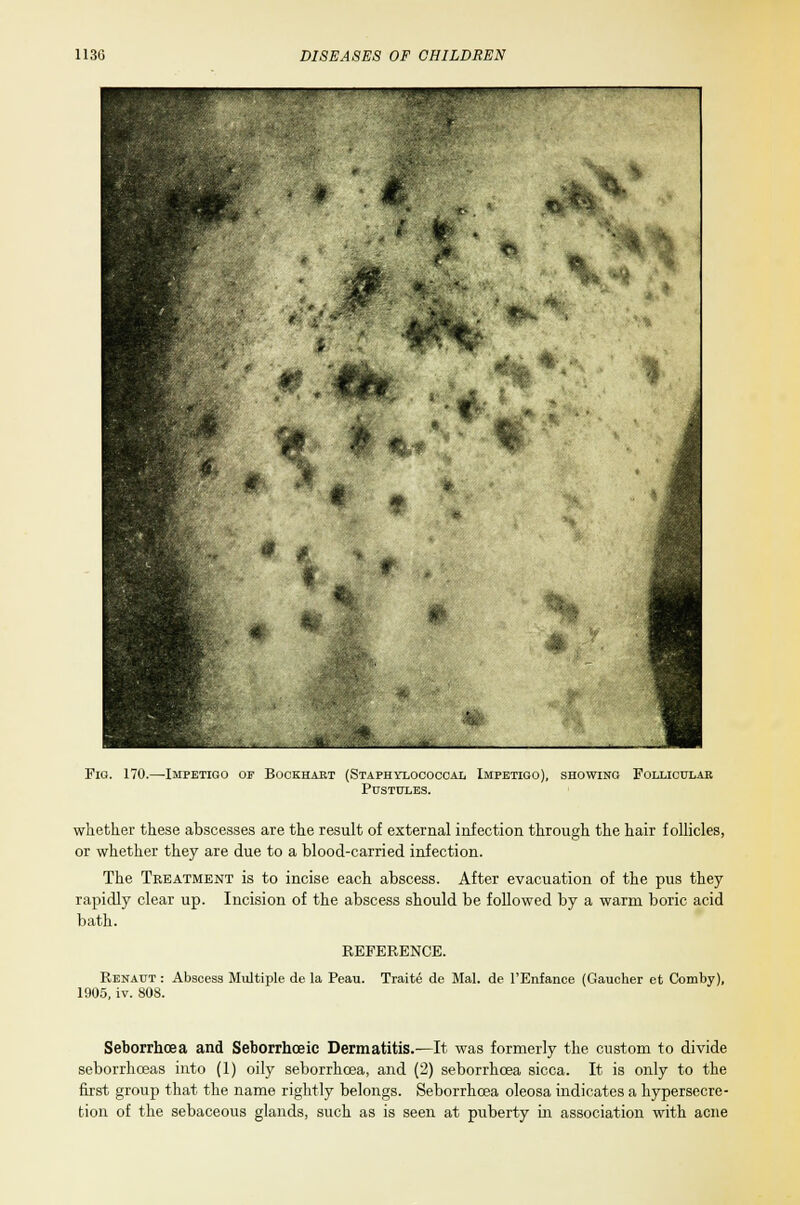 Fig. 170.—-Impetigo of Bockhart (Staphylococcal Impetigo), showing Follicular Pustules. whether these abscesses are the result of external infection through the hair follicles, or whether they are due to a blood-carried infection. The Treatment is to incise each abscess. After evacuation of the pus they rapidly clear up. Incision of the abscess should be followed by a warm boric acid bath. REFERENCE. Renaut : Abscess Multiple de la Peau. Traits de Mai. de l'Enfance (Gaucher et Comby), 1905, iv. 808. Seborrhea and Seborrhceic Dermatitis.—It was formerly the custom to divide seborrhceas into (1) oily seborrhcea, and (2) seborrhoea sicca. It is only to the first group that the name rightly belongs. Seborrhcea oleosa indicates a hypersecre- tion of the sebaceous glands, such as is seen at puberty in association with acne