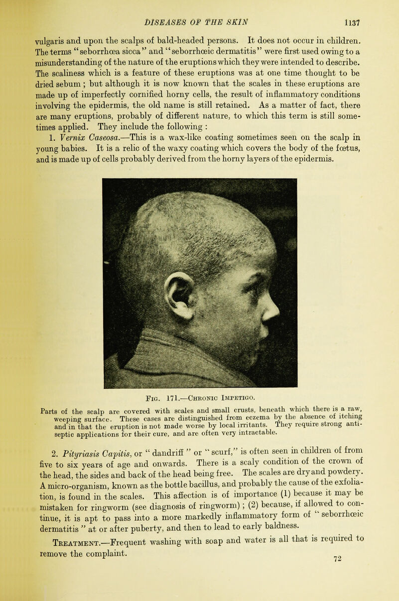 vulgaris and upon the scalps of bald-headed persons. It does not occur in children. The terms  seborrhcea sicca  and  seborrhceic dermatitis  were first used owing to a misunderstanding of the nature of the eruptions which they were intended to describe. The scaliness which is a feature of these eruptions was at one time thought to be dried sebum; but although it is now known that the scales in these eruptions are made up of imperfectly cornified horny cells, the result of inflammatory conditions involving the epidermis, the old name is still retained. As a matter of fact, there are many eruptions, probably of different nature, to which this term is still some- times applied. They include the following : 1. Vernix Caseosa.—This is a wax-like coating sometimes seen on the scalp in young babies. It is a relic of the waxy coating which covers the body of the foetus, and is made up of cells probably derived from the horny layers of the epidermis. Fig. 171.—Chronic Impetigo. Parts of the scalp are covered with scales and small crusts, beneath which there is a raw, weeping surface. These cases are distinguished from eczema by the absence of itching and in that the eruption is not made worse by local irritants. They require strong anti- septic applications for their cure, and are often very intractable. 2. Pityriasis Capitis, or  dandrifi  or  scurf, is often seen in children of from five to six years of age and onwards. There is a scaly condition of the crown of the head, the sides and back of the head being free. The scales are dry and powdery. A micro-organism, known as the bottle bacillus, and probably the cause of the exfolia- tion, is found in the scales. This afiection is of importance (1) because it may be mistaken for ringworm (see diagnosis of ringworm); (2) because, if allowed to con- tinue, it is apt to pass into a more markedly inflammatory form of  seborrhceic dermatitis  at or after puberty, and then to lead to early baldness. Treatment.—Frequent washing with soap and water is all that is required to remove the complaint.