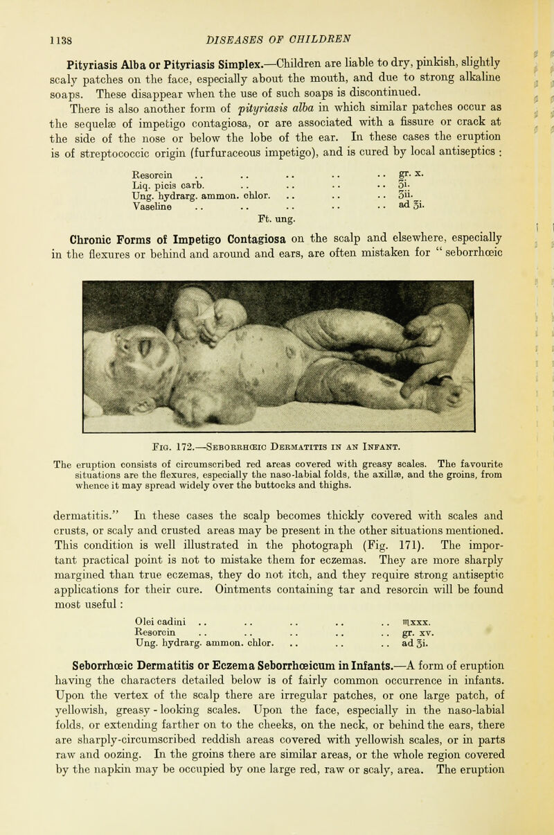 Pityriasis Alba or Pityriasis Simplex.—Children are liable to dry, pinkish, slightly scaly patches on the face, especially about the mouth, and due to strong alkaline soaps. These disappear when the use of such soaps is discontinued. There is also another form of pityriasis alba in which similar patches occur as the sequelae of impetigo contagiosa, or are associated with a fissure or crack at the side of the nose or below the lobe of the ear. In these cases the eruption is of streptococcic origin (furfuraceous impetigo), and is cured by local antiseptics : Resorcin Liq. picis carb. Ung. hydrarg. amnion, chlor. Vaseline Ft. ung gr. x. 5i- 5ii- ad gi. Chronic Forms of Impetigo Contagiosa on the scalp and elsewhere, especially in the flexures or behind and around and ears, are often mistaken for  seborrhceic Fig. 172.—Seborrheic Dermatitis in an Infant. The eruption consists of circumscribed red areas covered with greasy scales. The favourite situations are the flexures, especially the naso-labial folds, the axillae, and the groins, from whence it may spread widely over the buttocks and thighs. dermatitis. In these cases the scalp becomes thickly covered with scales and crusts, or scaly and crusted areas may be present in the other situations mentioned. This condition is well illustrated in the photograph (Fig. 171). The impor- tant practical point is not to mistake them for eczemas. They are more sharply margined than true eczemas, they do not itch, and they require strong antiseptic applications for their cure. Ointments containing tar and resorcin will be found most useful: Olei cadini Resorcin Ung. hydrarg. amnion, chlor. mxxx. gr. xv. adgi. Seborrhceic Dermatitis or Eczema Seborrhceicum in Infants.—A form of eruption having the characters detailed below is of fairly common occurrence in infants. Upon the vertex of the scalp there are irregular patches, or one large patch, of yellowish, greasy - looking scales. Upon the face, especially in the naso-labial folds, or extending farther on to the cheeks, on the neck, or behind the ears, there are sharply-circumscribed reddish areas covered with yellowish scales, or in parts raw and oozing. In the groins there are similar areas, or the whole region covered by the napkin may be occupied by one large red, raw or scaly, area. The eruption
