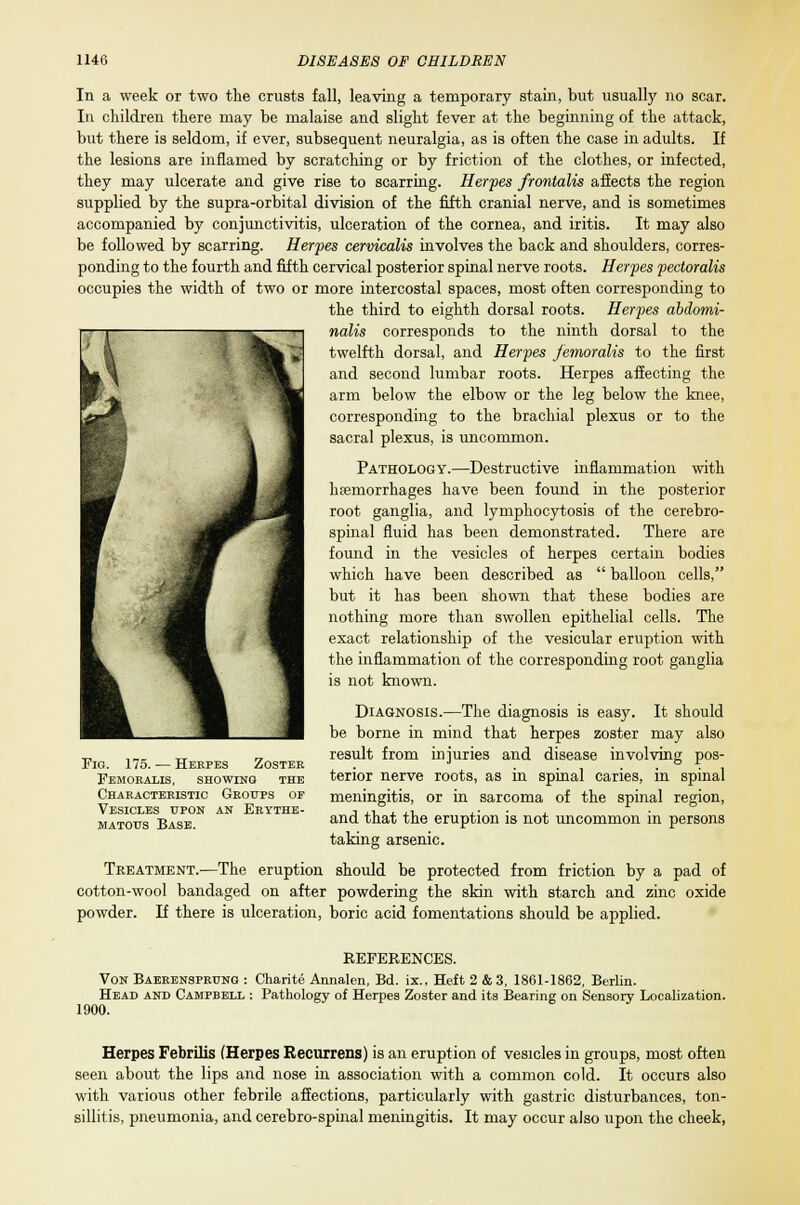 In a week or two the crusts fall, leaving a temporary stain, but usually no scar. In children there may be malaise and slight fever at the beginning of the attack, but there is seldom, if ever, subsequent neuralgia, as is often the case in adults. If the lesions are inflamed by scratching or by friction of the clothes, or infected, they may ulcerate and give rise to scarring. Herpes frontalis affects the region supplied by the supra-orbital division of the fifth cranial nerve, and is sometimes accompanied by conjunctivitis, ulceration of the cornea, and iritis. It may also be followed by scarring. Herpes cervicalis involves the back and shoulders, corres- ponding to the fourth and fifth cervical posterior spinal nerve roots. Herpes pectoralis occupies the width of two or more intercostal spaces, most often corresponding to the third to eighth dorsal roots. Herpes abdomi- nalis corresponds to the ninth dorsal to the twelfth dorsal, and Herpes femoralis to the first and second lumbar roots. Herpes affecting the arm below the elbow or the leg below the knee, corresponding to the brachial plexus or to the sacral plexus, is uncommon. Pathology.—Destructive inflammation with haemorrhages have been found in the posterior root ganglia, and lymphocytosis of the cerebro- spinal fluid has been demonstrated. There are found in the vesicles of herpes certain bodies which have been described as  balloon cells, but it has been shown that these bodies are nothing more than swollen epithelial cells. The exact relationship of the vesicular eruption with the inflammation of the corresponding root ganglia is not known. Diagnosis.—The diagnosis is easy. It should be borne in mind that herpes zoster may also result from injuries and disease involving pos- terior nerve roots, as in spinal caries, in spinal meningitis, or in sarcoma of the spinal region, and that the eruption is not uncommon in persons taking arsenic. Treatment.—The eruption should be protected from friction by a pad of cotton-wool bandaged on after powdering the skin with starch and zinc oxide powder. If there is ulceration, boric acid fomentations should be applied. Fig. 175. — Herpes Zostee Femoralis, showing the Characteristic Groups of Vesicles upon an Erythe- matous Base. REFERENCES. Von Baerensprunq : Charite Annalen, Bd. ix., Heft 2 &3, 1861-1862, Berlin. Head and Campbell : Pathology of Herpes Zoster and its Bearing on Sensory Localization. 1900. Herpes Febrilis (Herpes Recurrens) is an eruption of vesicles in groups, most often seen about the lips and nose in association with a common cold. It occurs also with various other febrile affections, particularly with gastric disturbances, ton- sillitis, pneumonia, and cerebro-spinal meningitis. It may occur aJso upon the cheek,