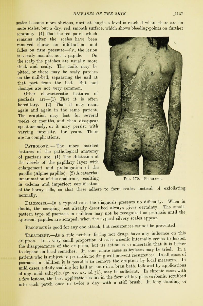 scales become more obvious, until at length a level is reached where there are no more scales, but a dry, red, smooth surface, which shows bleeding-points on further scraping. (4) That the red patch which remains after the scales have been removed shows no infiltration, and fades on firm pressure—i.e., the lesion is a scaly macule, not a papule. On the scalp the patches are usually more thick and scaly. The nails may be pitted, or there may be scaly patches on the nail-bed, separating the nail at that part from the bed. But nail changes are not very common. Other characteristic features of psoriasis are—(1) That it is often hereditary. (2) That it may recur again and again in the same patient. The eruption may last for several weeks or months, and then disappear spontaneously, or it may persist, with varying intensity, for years. There are no complications. Pathology. — The more marked features of the pathological anatomy of psoriasis are—(1) The dilatation of the vessels of the papillary layer, with enlargement and prolongation of the papillee (Alpine papillae). (2) A catarrhal inflammation of the epidermis, resulting in oedema and imperfect cornification of the horny cells, so that these adhere normally. Diagnosis.—In a typical case the diagnosis presents no difficulty. When in doubt, the scraping test already described always gives certainty. The small- pattern type of psoriasis in children may not be recognized as psoriasis until the apparent papules are scraped, when the typical silvery scales appear. Prognosis is good for any one attack, but recurrences cannot be prevented. Treatment.—As a rule neither dieting nor drugs have any influence on this eruption. In a very small proportion of cases arsenic internally seems to hasten the disappearance of the eruption, but its action is so uncertain that it is better to depend on local remedies. In some acute cases salicylates may be tried. In a patient who is subject to psoriasis, no drug will prevent recurrences In all cases of psoriasis in children it is possible to remove the eruption by local measures In mild cases, a daily soaking for half an hour in a bran bath, followed by applications of ung. acid, salicylic, (gr. xv.-xx. ad 5i.), may be sufficient. In chrome cases with a few lesions, the best application is tar in the form of liq. picis carboms, scrubbed into each patch once or twice a day with a stiff brush. In long-standing or •Psoriasis. to form scales instead of exfoliating