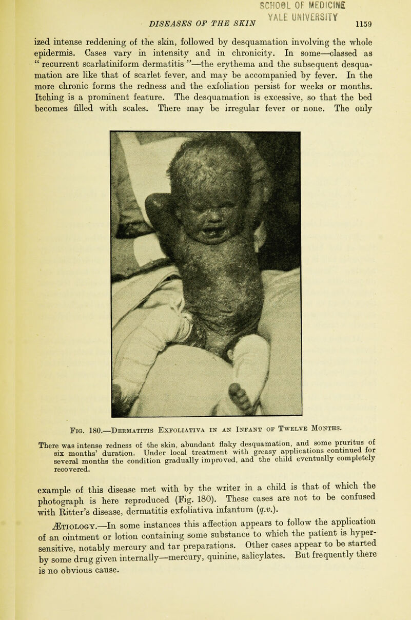 SCH08L OF MEDICINE YALE UNIVERSITY ized intense reddening of the skin, followed by desquamation involving the whole epidermis. Cases vary in intensity and in chronicity. In some—classed as  recurrent scarlatiniform dermatitis —the erythema and the subsequent desqua- mation are like that of scarlet fever, and may be accompanied by fever. In the more chronic forms the redness and the exfoliation persist for weeks or months. Itching is a prominent feature. The desquamation is excessive, so that the bed becomes filled with scales. There may be irregular fever or none. The only Fig. 180.—Dermatitis Exfoliativa in an Infant of Twelve Months. There was intense redness of the skin, abundant flaky desquamation, and some pruritus of six months' duration. Under local treatment with greasy applications continued for several months the condition gradually improved, and the child eventually completely recovered. example of this disease met with by the writer in a child is that of which the photograph is here reproduced (Fig. 180). These cases are not to be confused with Bitter's disease, dermatitis exfoliativa infantum (q.v.). ^Etiology.—In some instances this affection appears to follow the application of an ointment or lotion containing some substance to which the patient is hyper- sensitive, notably mercury and tar preparations. Other cases appear to be started by some drug given internally—mercury, quinine, salicylates. But frequently there is no obvious cause.