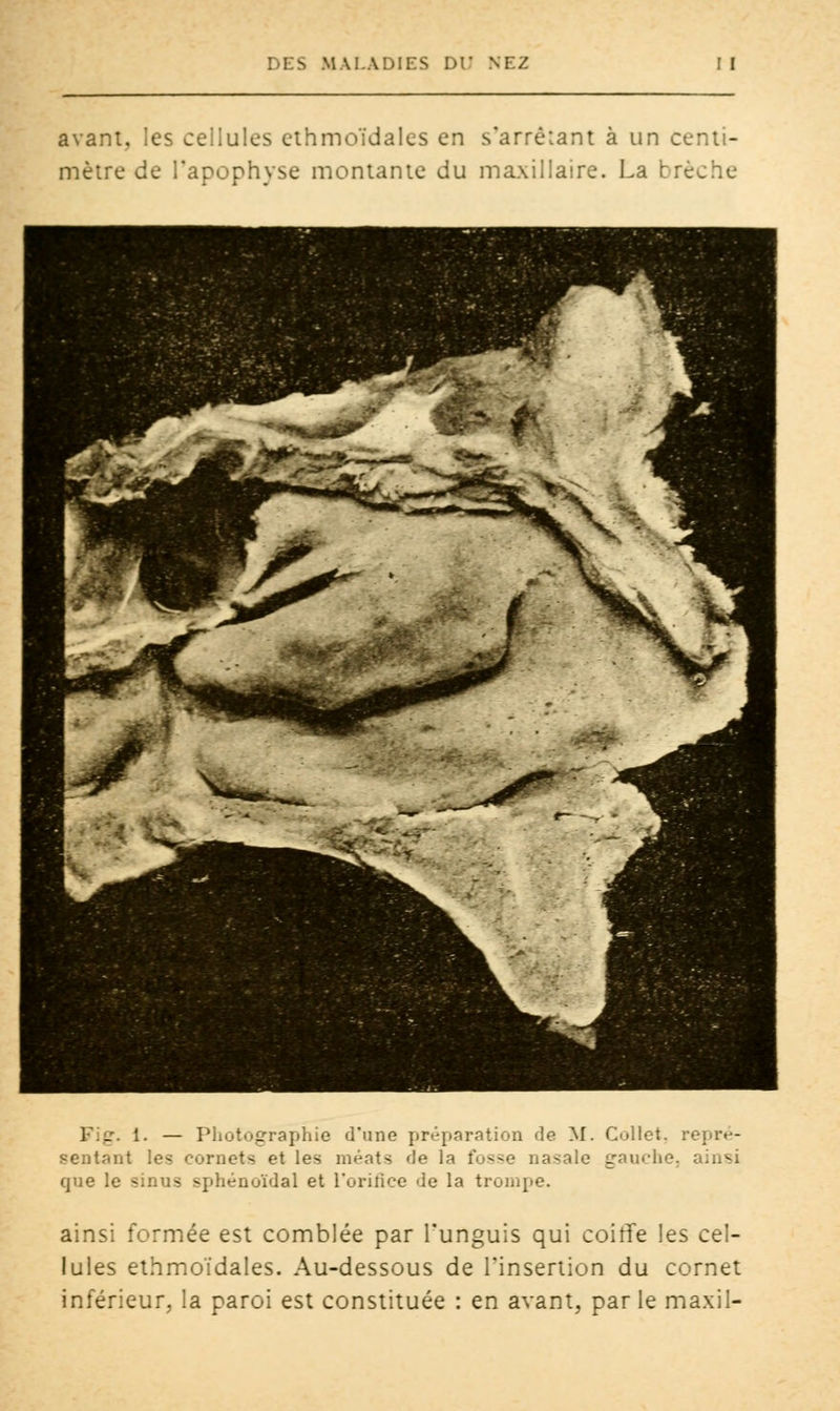 avant, les cellules cthmoïdales en s'arrèiant à un centi- mètre de l'apophyse montante du maxillaire. La brèche ]■._-. 1. — Photographie d'une préparation de M. Collet, repré- sentant les cornets et les méats de la fosse nasale gauche, ainsi que le sinus sphénoïdal et L'orifice de la trompe. ainsi formée est comblée par l'unguis qui coiffe les cel- lules ethmoïdales. Au-dessous de l'insertion du cornet inférieur, la paroi est constituée : en avant, par le maxil-