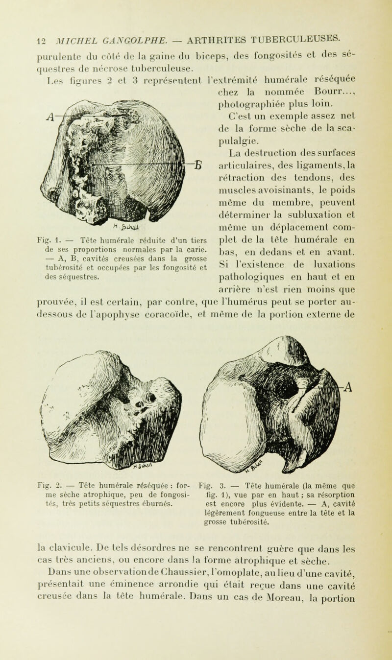 purulente du côté de la gaine du biceps, des fongosités et des sé- questres de nécrose tuberculeuse. Les figures ~1 et 3 représentent l'extrémité numérale réséquée chez la nommée Bourr..., photographiée plus loin. C'est un exemple assez net de la forme sèche de la sca- pulalgie. La destruction des surfaces articulaires, des ligaments,la rétraction des tendons, des muscles avoisinants, le poids môme du membre, peuvent déterminer la subluxation et i**i môme un déplacement com- Fig. 1. — Tête humérale réduite d'un tiers plet de la tête numérale en de ses proportions normales par la carie. ]jas; ell dedans gt, en avant — A, B, cavités creusées dans la grosse . ',, . . tubérosité et occupées par les fongosité et bl ' existence de luxations des séquestres. pathologiques en haut et en arrière n'est rien moins que prouvée, il est certain, par contre, que l'humérus peut se porter au- dessous de l'apophyse coracoïde, et même de la portion externe de Fig. 2. — Tête humérale réséquée : for- me sèche atrophique, peu de fongosi- tés, très petits séquestres éburnés. Fig. 3. — Tête humérale (la même que fig. 1), vue par en haut ; sa résorption est encore plus évidente. — A, cavité légèrement fongueuse entre la tête et la grosse tubérosité. la clavicule. De tels désordres ne se rencontrent guère que dans les cas très anciens, ou encore dans !a forme atrophique et sèche. Dans une observation de Chaussier, l'omoplate, au lieu d'une cavité, présentait une éminence arrondie qui était reçue dans une cavité creusée dans la tète humérale. Dans un cas de Moreau, la portion