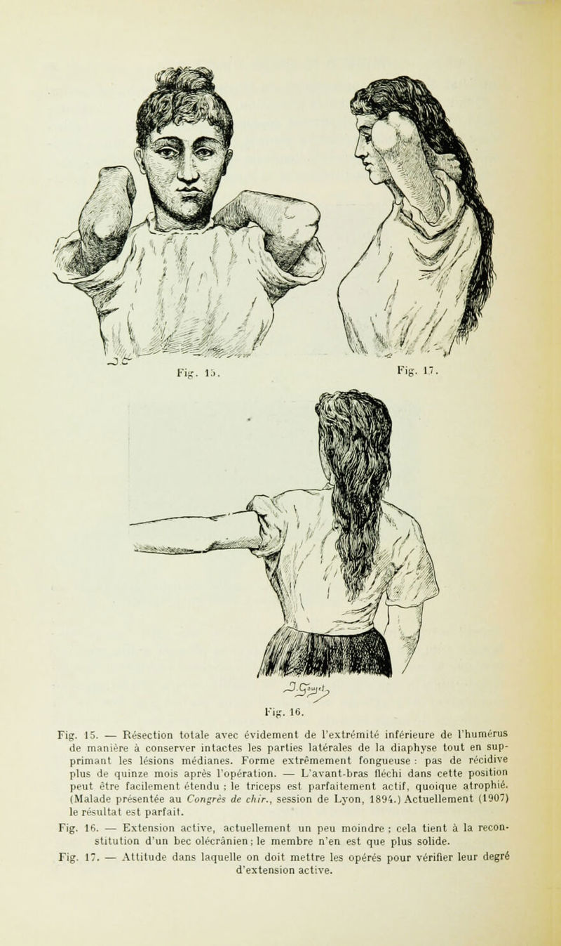 Jï Fie. la. Fie. 17. Fig. 15. — Résection totale avec évidement de l'extrémité inférieure de l'humérus de manière à conserver intactes les parties latérales de la diaphyse tout en sup- primant les lésions médianes. Forme extrêmement fongueuse : pas de récidive plus de quinze mois après l'opération. — L'avant-bras fléchi dans cette position peut être facilement étendu ; le triceps est parfaitement actif, quoique atrophié. (Malade présentée au Congrès de chir., session de Lyon, 1894.) Actuellement (1907) le résultat est parfait. Fig. 16. — Extension active, actuellement un peu moindre ; cela tient à la recon- stitution d'un bec olécrânien ; le membre n'en est que plus solide. Fig. 17. — Attitude dans laquelle on doit mettre les opérés pour vérifier leur degré d'extension active.