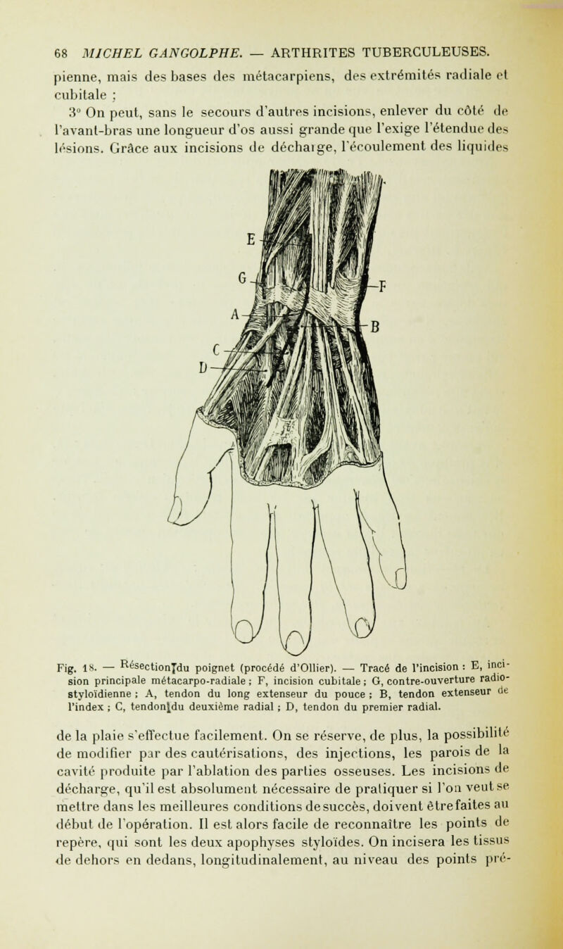 pienne, mais des bases des métacarpiens, des extrémités radiale et cubitale ; 3° On peut, sans le secours d'autres incisions, enlever du côté de l'avant-bras une longueur d'os aussi grande que l'exige l'étendue des lésions. Grâce aux incisions de déchaige, l'écoulement des liquides Fig. 18. — RésectionJdu poignet (procédé d'Ollier). — Tracé de l'incision : E, inci- sion principale métacarpo-radiale ; F, incision cubitale ; G, contre-ouverture radio- styloïdienne ; A, tendon du long extenseur du pouce ; B, tendon extenseur de l'index ; C, tendonjdu deuxième radial ; D, tendon du premier radial. de la plaie s'effectue facilement. On se réserve, de plus, la possibilité de modifier par des cautérisations, des injections, les parois de la cavité produite par l'ablation des parties osseuses. Les incisions de décharge, qu'il est absolument nécessaire de pratiquer si l'on veut se mettre dans les meilleures conditions de succès, doivent être faites au début de l'opération. Il est alors facile de reconnaître les points de repère, qui sont les deux apophyses styloïdes. On incisera les tissus de dehors en dedans, longitudinalement, au niveau des points pré-
