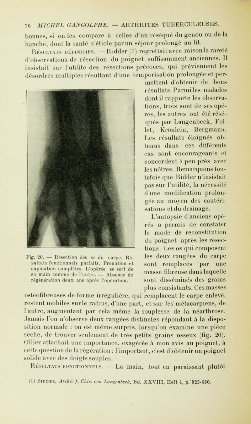 bonnes, si on les compare à celles d'un réséqué du genou ou de la hanche, dont la santé s'étiole parun séjour prolongé au lit. Résultats définitifs. — Bidder il) regrettait avec raison la rareté d'observations de résection du poignet suffisamment anciennes. Il insistait sur l'utilité des résections précoces, qui préviennent les désordres multiples résultant dune temporisation prolongée et per- mettent d'obtenir de bons résultats. Parmi les malades dont il rapporte les observa- lions, trois sont de ses opé- rés, les autres ont été résé- qués par Langenbeck, Fol- let, Kronlein, Bergmann. Les résultats éloignés ob- tenus dans ces différents cas sont, encourageants et concordent à peu près avec les nôtres. Remarquons tou- tefois que Bidder n'insistait pas sur l'utilité, la nécessité d'une modification prolon- ger au moyen des cautéri- sations et du drainage. L'autopsie d'anciens opé- rés a permis de constater le mode de reconstitution du poignet après les résec- tions. Les os qui composent les deux rangées du carpe sont remplacés par une masse fibreuse dans laquelle sont disséminés des grains plus consistants. Ces masses ostéofibreuses de forme irrégulière, qui remplacent le carpe enlevé, restent mobiles surle radius, d'une part, et sur les métacarpiens, de l'autre, augmentant par cela môme la souplesse de la néarthrose. Jamais l'on n'observe deux rangées distinctes répondant à la dispo- sition normale : on est même surpris, lorsqu'on examine une pièce sèche, de trouver seulement de très petits grains osseux (fig. 20). Ollier attachait une importance, exagérée à mon avis au poignet, à cette question de la régération: l'important, c'est d'obtenir un poignet solide avec des doigts souples. Résultats fonctionnels. — La main, tout en paraissant plutôt Fig. 20. — Résection des os du carpe. Ré- sultats fonctionnels parfaits. Pronation et supination complètes. L'opérée se sert de sa main comme de l'autre. — Absence de régénération deux ans après l'opération. (1) Bidder, Archivj. Chir. von Langenbeck, Bd. XXVIII, Heft 4, p.'823-680.