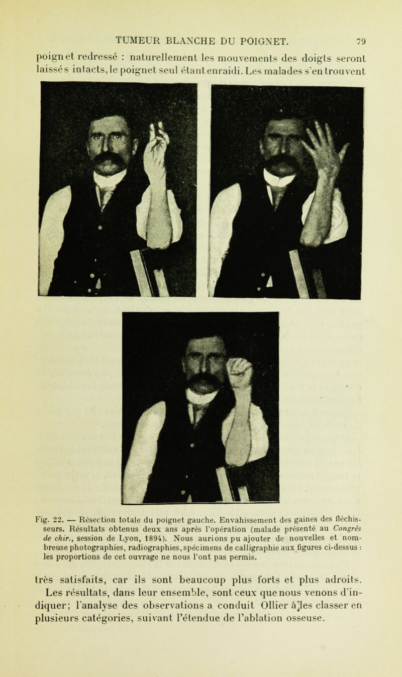 poignet redressé : naturellement les mouvements des doigts seront laissés intacts, le poignet seul étantenraidi. Les malades s'en trouvent Fig. 22. — Résection totale du poignet gauche. Envahissement des gaines des fléchis- seurs. Résultats obtenus deux ans après l'opération (malade présenté au Congrès de chir., session de Lyon, 1894). Nous aurions pu ajouter de nouvelles et nom- breuse photographies, radiographies,spécimens de calligraphie aux figures ci-dessus : les proportions de cet ouvrage ne nous l'ont pas permis. très satisfaits, car ils sont beaucoup plus forts et plus adroits. Les résultats, dans leur ensemble, sont ceux que nous venons d'in- diquer; l'analyse des observations a conduit Ollier àjles classer en plusieurs catégories, suivant l'étendue de l'ablation osseuse.
