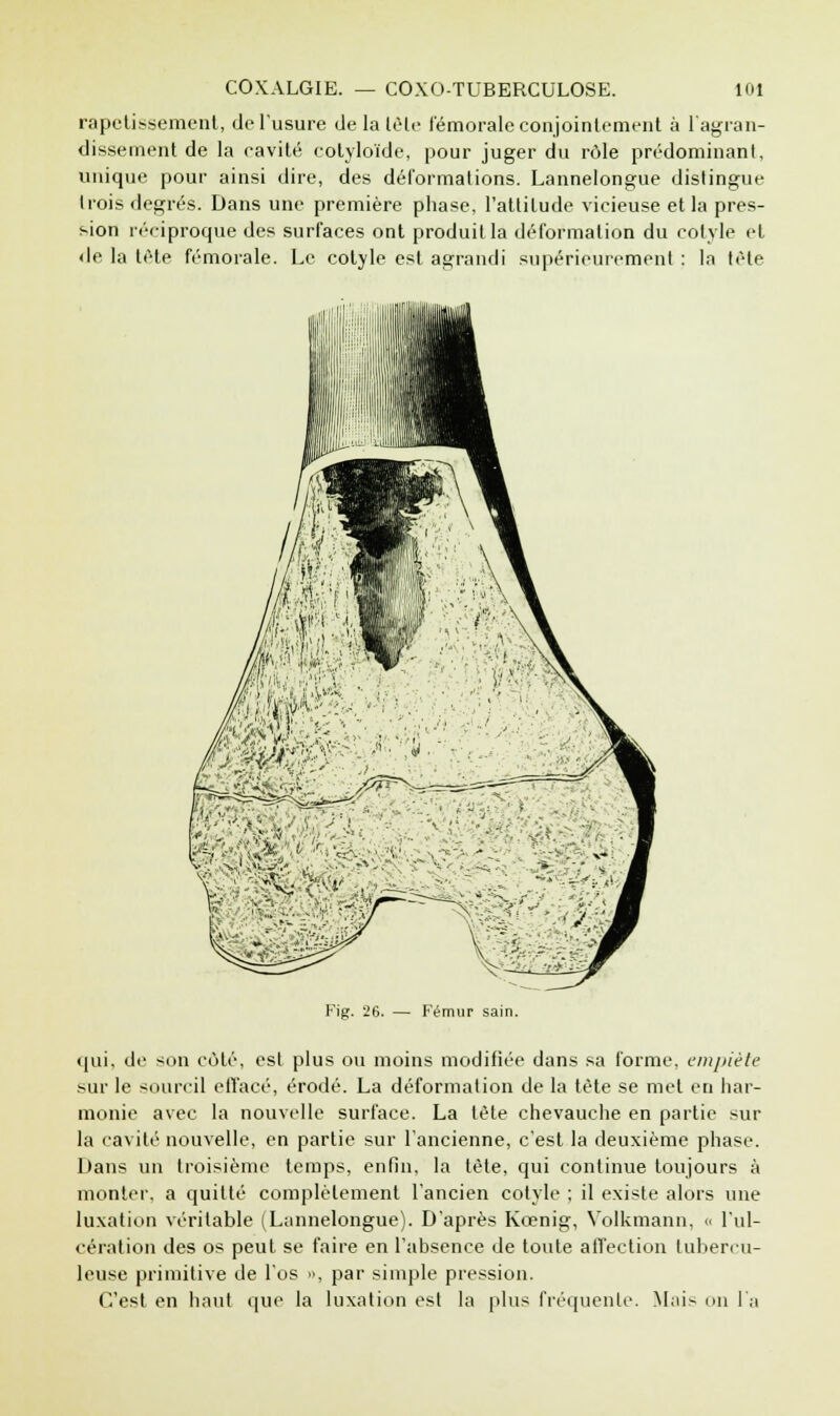 rapetissement, de l'usure de la tète fémorale conjointement à l'agran- dissement de la eavité cotyloïde, pour juger du rôle prédominant, unique pour ainsi dire, des déformations. Lannelongue distingue trois degrés. Dans une première phase, l'attitude vicieuse et la pres- sion réciproque des surfaces ont produit la déformation du cotyle et de la tète fémorale. Le cotyle est agrandi supérieurement : la tète i::^ wvÀliâ;;1 -.1 \ M'Ai i:'V ' '' 1 ■JZH/ :«TSj ' ' ,,' y •' Fig. 26. — Fémur sain. qui, de son côté, est plus ou moins modifiée dans sa forme, empiète sur le sourcil etïacé, érodé. La déformation de la tète se met eu har- monie avec la nouvelle surface. La tête chevauche en partie sur la cavité nouvelle, en partie sur l'ancienne, c'est la deuxième phase. Dans un troisième temps, enfin, la tête, qui continue toujours à monter, a quitté complètement l'ancien cotyle ; il existe alors une luxation véritable (Lannelongue). D'après Kœnig, Volkmann, « l'ul- cération des os peut se faire en l'absence de toute affection tubercu- leuse primitive de l'os », par simple pression. C'est en haut que la luxation est la plus fréquente. Mais on l'a