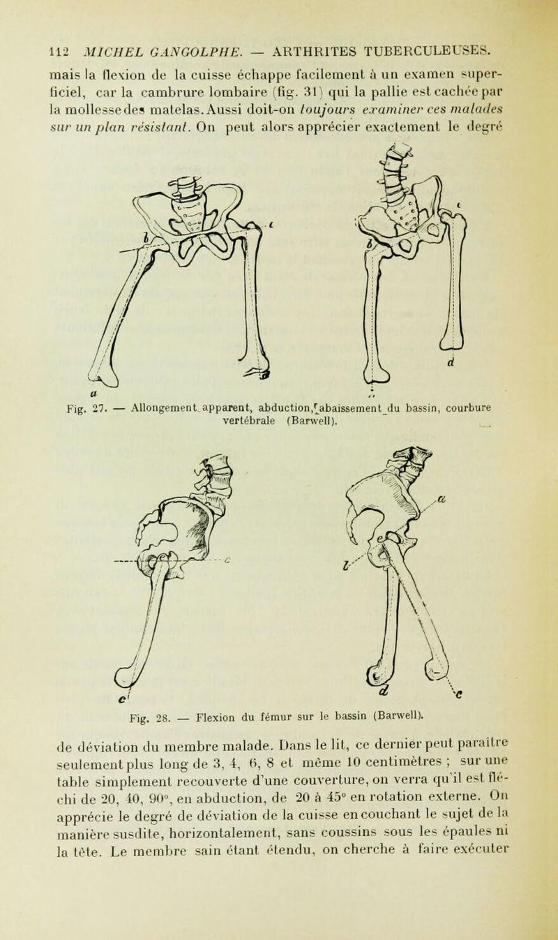 mais la flexion de la cuisse échappe facilement à un examen super- ficiel, car la cambrure lombaire (fig. 31) qui la pallie est cachée par la mollessedes matelas. Aussi doit-on toujours examiner ces malades sur un plan résistant. On peut alors apprécier exactement le degré Allongement apparent, abduction,[abaissement_du bassin, courbure vertébrale (Barwell). Fig. 28. — Flexion du fémur sur le bassin (Barwell). de déviation du membre malade. Dans le lit, ce dernier peut paraître seulement plus long de 3, 4, 6, 8 et même 10 centimètres ; sur une table simplement recouverte d'une couverture, on verra qu'il est flé- chi de 20, 40, 90°, en abduction, de 20 à 45° en rotation externe. On apprécie le degré de déviation de la cuisse en couchant le sujet de la manière susdite, horizontalement, sans coussins sous les épaules ni la tète. Le membre sain étant ('tendu, on cherche à faire exécuter