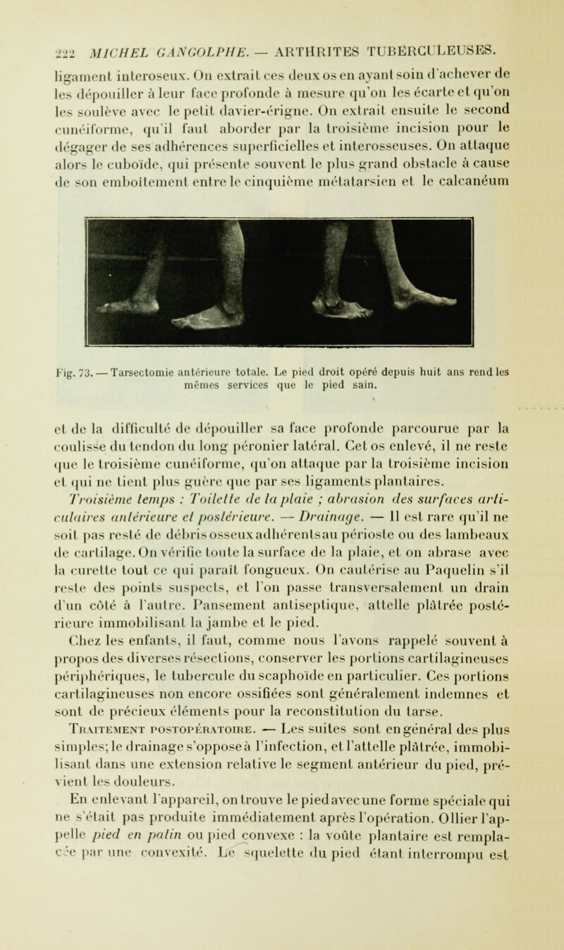 ligament interoseux. On extrait ces deux os eu ayantsoin d'achever de 1rs dépouiller à leur face profonde à mesure qu'on les écarte et qu'on les soulève avec le petit davier-érigne. On extrait ensuite le second cunéiforme, qu'il faut aborder par la troisième incision pour le dégager «le ses adhérences superficielles et interosseuses. On attaque alors le cuboïde, qui présente souvent le plus grand obstacle à cause de son emboîtement entre le cinquième métatarsien et le calcanéum l'ig. 73. — Tarsectomie antérieure totale. Le pied droit opéré depuis huit ans rend lus mûmes services que le pied sain. et de la difficulté de dépouiller sa face profonde parcourue par la coulisse du tendon du long péronier latéral. Cet os enlevé, il ne reste que le troisième cunéiforme, qu'on attaque parla troisième incision cl qui ne tient plus guère (pie par ses ligaments plantaires. Troisième temps : Toilette île la plaie ; abrasion des surfaces arti- culaires antérieure el postérieure. —Drainage. — 11 est rare qu'il ne soit pas resté de débris osseux adhérents au périoste ou des lambeaux de cartilage. On vérifie toute la surface de la plaie, et on abrase avec la curette tout ce qui parait fongueux. On cautérise au Paquelin s'il reste des points suspects, et l'on passe transversalement un drain d'un côté à l'autre. Pansement antiseptique, attelle plâtrée posté- rieure immobilisant la jambe et le pied. Chez les enfants, il faut, comme nous l'avons rappelé souvent à propos des diverses résections, conserver les portions cartilagineuses périphériques, le tubercule duscaphoïdeen particulier. Ces portions cartilagineuses non encore ossifiées sont généralement indemnes et sont de précieux éléments pour la reconstitution du tarse. Traitement postopératoire. — Les suites sont en général des plus simples; le drainage s'opposeà l'infection, et l'attelle plâtrée, immobi- lisant dans une extension relative le segment antérieur du pied, pré- vienl les douleurs. En enlevant l'appareil, on trouve le piedavecune forme spéciale qui ne s'était pas produite immédiatement après l'opération. Ollier l'ap- pelle pied en patin ou pied convexe : la voûte plantaire est rempla- céeparune convexité. Le squelette du pied étant interrompu est