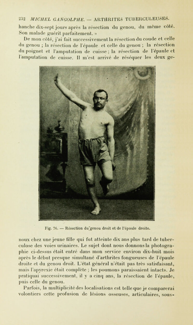 hanche dix-sept jours après la résection du genou, du même côté. Son malade guérit parfaitement. » De mon côté, j'ai fait successivement la résection du coude et celle du genou ; la résection de l'épaule et celle du genou ; la résection du poignet et l'amputation de cuisse; la résection de l'épaule et l'amputation de cuisse. Il m'est arrivé de réséquer les deux ge- Fig. 76. — Résection diTgenou droit et de l'épaule droite. noux chez une jeune fdle qui fut atteinte dix ans plus tard de tuber- culose des voies urinaires. Le sujet dont nous donnons la photogra- phie ci-dessus était entré dans mon service environ dix-huit mois après le début presque simultané d'arthrites fongueuses de l'épaule droite et du genou droit. L'état général n'était pas très satisfaisant, mais l'apyrexie étail complète ; les poumons paraissaient intacts. Je pratiquai successivement, il y a cinq ans, la résection de l'épaule, puis celle du genou. Parfois, la multiplicité des localisations est telle que je comparerai volontiers cette profusion de lésions osseuses, articulaires, sous-