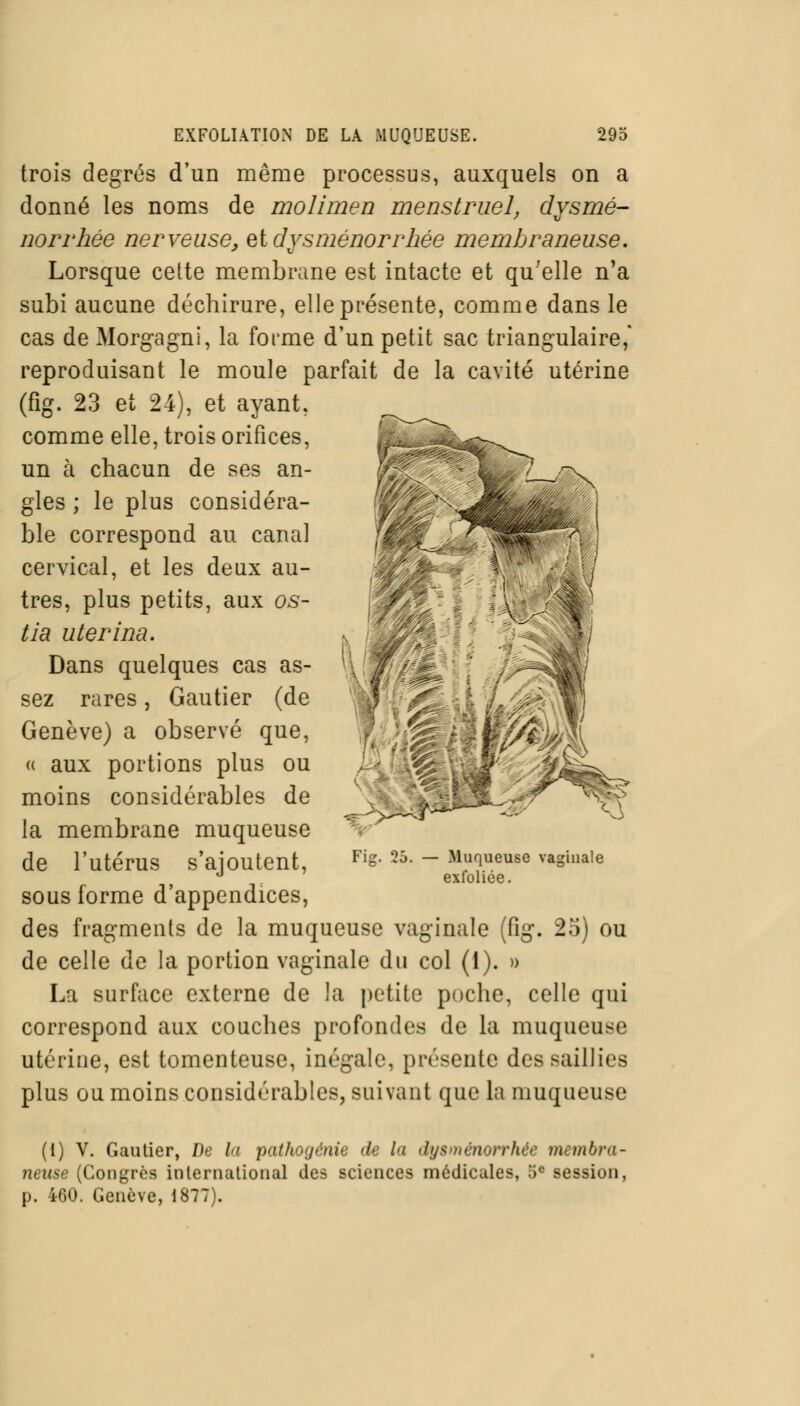 trois degrés d'un même processus, auxquels on a donné les noms de molimen menstruel, dysmé- norrhée nerveuse, si dysménorrhée membraneuse. Lorsque cette membrane est intacte et qu'elle n'a subi aucune déchirure, elle présente, comme dans le cas de Morgagni, la forme d'un petit sac triangulaire, reproduisant le moule parfait de la cavité utérine (fig. 23 et 24), et ayant, comme elle, trois orifices, un à chacun de ses an- gles ; le plus considéra- ble correspond au canal cervical, et les deux au- tres, plus petits, aux os- tia uterina. Dans quelques cas as- sez rares, Gautier (de Genève) a observé que, « aux portions plus ou moins considérables de la membrane muqueuse de l'utérus s'ajoutent, sous forme d'appendices, des fragments de la muqueuse vaginale (fig. 25) ou de celle de la portion vaginale du col (1). » La surface externe de la petite poche, celle qui correspond aux couches profondes de la muqueuse utérine, est tomenteuse, inégale, présente des saillies plus ou moins considérables, suivant que la muqueuse Fig. 25. Muqueuse vaginale exfoliée. (1) V. Gautier, De l<i pathogène de la dysménorrhée membra- neuse (Congrès international des sciences médicales, ;ic session, p. 460. Genève, 1877).