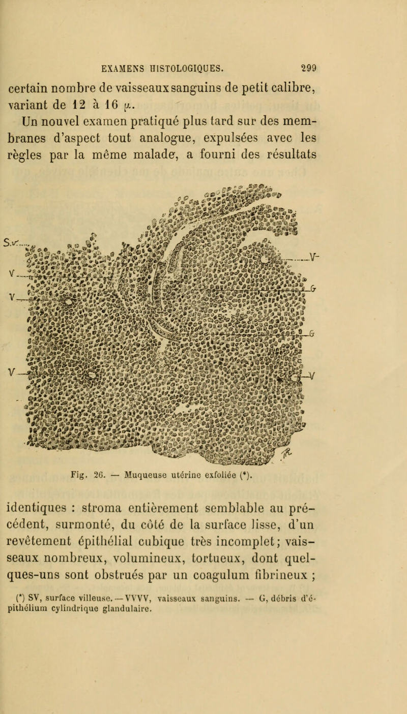 certain nombre de vaisseaux sanguins de petit calibre, variant de 12 à 16 u.. Un nouvel examen pratiqué plus tard sur des mem- branes d'aspect tout analogue, expulsées avec les règles par la même malade, a fourni des résultats Fig. 2G. — Muqueuse utérine exfol liée (*). identiques : stroma entièrement semblable au pré- cédent, surmonté, du coté de la surface lisse, d'un revêtement épithélial cubique très incomplet; vais- seaux nombreux, volumineux, tortueux, dont quel- ques-uns sont obstrués par un coagulum fibrineux ; (*) SV, surface villeuse. — VYVV, vaisseaux sanguins, pithélium cylindrique glandulaire. G, débris d'é-