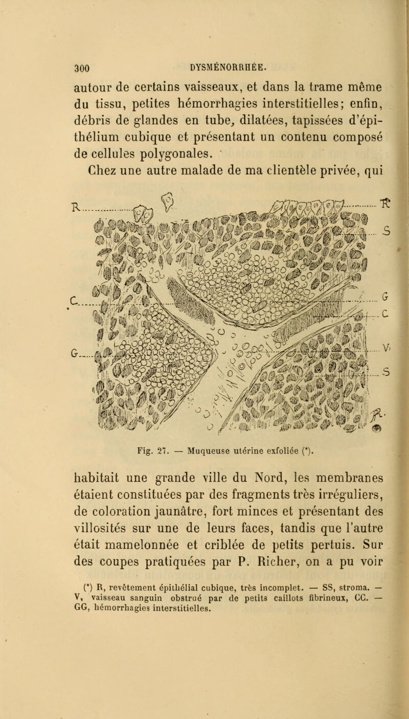 autour de certains vaisseaux, et dans la trame même du tissu, petites hémorrhagies interstitielles; enfin, débris de glandes en tube, dilatées, tapissées d'épi- thélium cubique et présentant un contenu composé de cellules polygonales. Chez une autre malade de ma clientèle privée, qui 0h m i ®y 0 s» # wm» m Fig. 27. — Muqueuse utérine exfoliée (*). habitait une grande ville du Nord, les membranes étaient constituées par des fragments très irréguliers, de coloration jaunâtre, fort minces et présentant des villosités sur une de leurs faces, tandis que l'autre était mamelonnée et criblée de petits pertuis. Sur des coupes pratiquées par P. Richer, on a pu voir (*) R, revêtement épithélial cubique, très incomplet. — SS, stroma. — V, vaisseau sanguin obstrué par de petits caillots fibrineux, CC. — GG, hémorrhagies interstitielles.