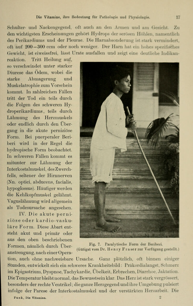 Schulter- und Nackengegend, oft auch an den Armen und am Gesicht '/. den wichtigsten Erscheinungen gehör! Hydrops d< . Höhlen, namentlich des Perikardiums und der Pleurae. Die Harnabsonderung i-1 ermindert, oft auf 200—300 com oder noch weniger. Der Harn hal ein hohes apezil Gewicht, ist eiweissfrei, lässt ürate ausfallen und zeigl eine deutliche (ndikan- reaktion. Tritt Heilung auf, so verschwindet unter starker Diurese das Ödem, wobei die starke Abmagerung und Muskelatrophie zum Vorschein kommt. In zahlreichen Fällen tritt der Tod ein teils durch die Folgen des schweren Hy- droperikardiums, teils durch Lähmung des Herzmuskels oder endlich durch den Über- gang in die akute perniziöse Form. Bei puerperaler Beri- beri wird in der Regel die hydropische Form beobachtet. In schweren Fällen kommt es mitunter zur Lähmung der Interkostalmuskel, des Zwerch- fells, seltener der Hirnnerven (Nu. optici, abducens, facialis, hypoglossus). Häufiger werden die Kehlkopfmuskel gelähmt. Vaguslähmung wird allgemein als Todesursache angesehen. IV. Die akute perni- ziöse oder kardio-vasku- lärePorm. Diese Abart ent- steht akut und primär oder aus den oben beschriebenen Formen, nämlich durch Über- anstrengung, nach einer Opera- tion, auch ohne nachweisbare Ursache. Ganz plötzlich, oft binnen einiger Stunden, entwickelt sich ein schweres Krankheitsbild : Präkordialangst. Schmerz im Epigastrium, Dyspnoe, Tachykardie, Übelkeit, Erbrechen, Diarrhoe. Jaktation. Die Temperatur bleibt normal, das Bewusstseinklar. Das Herz ist stark vergrössert, besonders der rechte Ventrikel; die ganze Herzgegend und ihre Umgebung pulsiert infolge der Parese der Interkostalmuskel und der verstärkten Herzarbeit. Die Funk, Die Vitamine. - Fig. 7. Paralytische Form der Beiiberi. (Gütigst vom Dr. He n ry F r a ser zur Verfügung gestellt.)