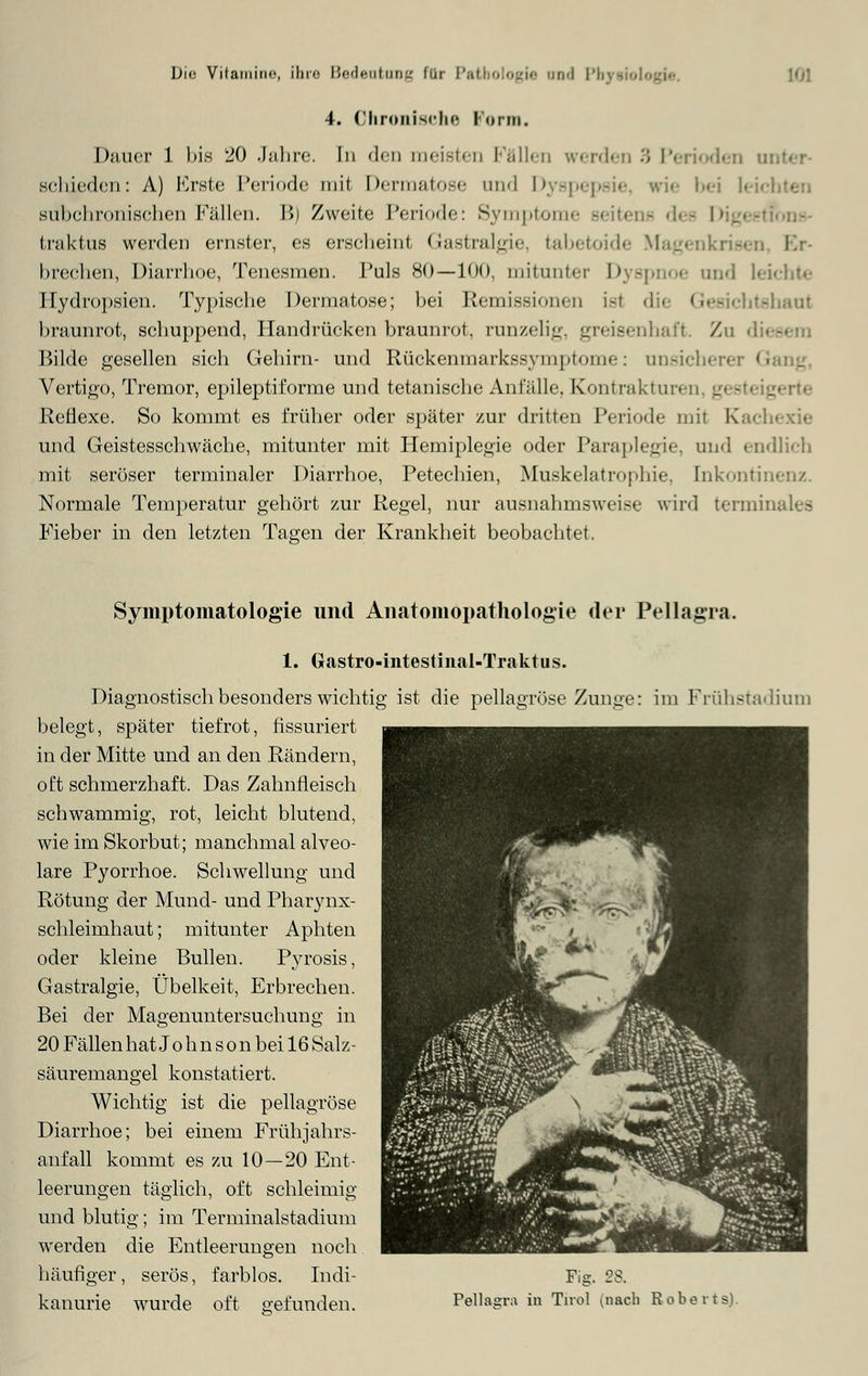 4. Chronische Form. Dauer 1 bis 20 Jahre. In den meisten Fällen werden •') Perioden o Bchieden: A) Erste Periode mit Dermatose und Dyspepsie, wie bei lei sii bei ironischen Fällen. 1b Zweit«; Periode: Symptome seitens des Digestions- traktus werden ernster, es erscheint Gastralgie, tabetoide Magenkrisen Ei brechen, Diarrhoe, Tenesmen. Pols 80—100. mitunter Dyspnoe und leichte Hydropsien. Typische Dermatose; bei Remissionen isl richtshaul braunrot, schuppend, Handrücken braunrot, ranzelig, greisenhaft. Zu d Bilde gesellen sich Gehirn- und Rückenmarkssymptome: unsichere G Vertigo, Tremor, epileptiforme und tetanische Anfälle. Kontrakturen, g< Reflexe. So kommt es früher oder später zur dritten Periode mil Kachexie und Geistesschwäche, mitunter mit Hemiplegie oder Paraplegie, und endlieh mit seröser terminaler Diarrhoe, Petechien, Muskelatrophie, [nkonti Normale Temperatur gehört zur Regel, nur ausnahmsweise wird terminales Fieber in den letzten Tagen der Krankheit beobachtet. Symptomatologie und Anatoniopathologie der Pellagra. 1. Gastro-intestiiial-Traktus. Diagnostisch besonders wichtig ist die pellagröse Zunge: im Frühstadium belegt, später tief rot, fissuriert in der Mitte und an den Rändern, oft schmerzhaft. Das Zahnfleisch schwammig, rot, leicht blutend, wie im Skorbut; manchmal alveo- lare Pyorrhoe. Schwellung und Rötung der Mund- und Pharynx- schleimhaut; mitunter Aphten oder kleine Bullen. Pyrosis, Gastralgie, Übelkeit, Erbrechen. Bei der Magenuntersuchung in 20 Fällenhat Johnson bei 16 Salz- säuremangel konstatiert. Wichtig ist die pellagröse Diarrhoe; bei einem Frühjahrs- anfall kommt es zu 10—20 Ent- leerungen täglich, oft schleimig und blutig; im Terminalstadium werden die Entleerungen noch häufiger, serös, farblos. Indi- Fig. 28. kanurie wurde oft gefunden. Pellagra in Tirol (nach Roberts).