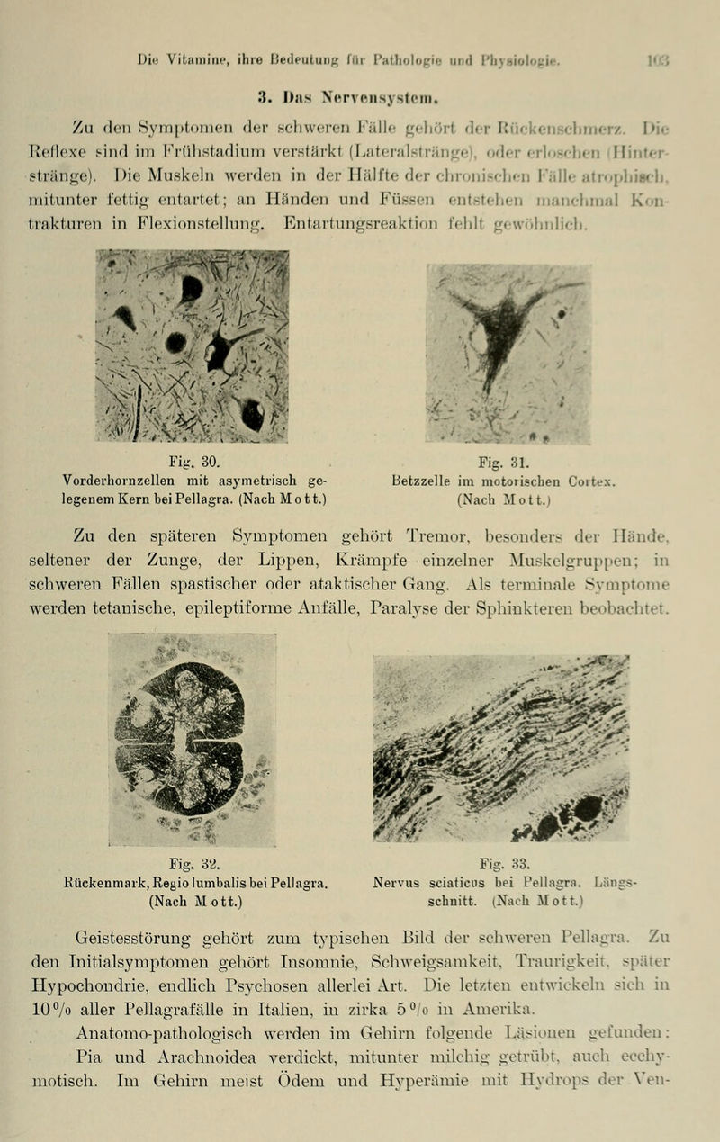 '.). Das Neryensj stein« Zu <lcn Symptomen der schweren Fälle gehör! der Rücken» • !•• Reflexe sind im Frühstadium verstärk! (Laterälstri der erloschen Hinter stränge). Die Muskeln werden in der Hälfte der chronischen Fälle atrophMcb, lnitunter fettig entartet; an Händen und Füssen entstehen manchmal I trakturen in Flexionstellung. Lnfartungsreaktion Eehll gewöhnlich. Fig. 30. Vorderhornzellen mit asymetrisch ge- legenem Kern bei Pellagra. (Nach M o 11.) Fig. 3t. Betzzelle im motorischen Cortex. (Nach Mott.) Zu den späteren Symptomen gehört Tremor, besonders der Hände, seltener der Zunge, der Lippen, Krämpfe einzelner Muskelgruppen; in schweren Fällen spastischer oder ataktischer Gang. Als terminale Symptome werden tetanische, epileptiforme Anfälle, Paralyse der Sphinktern! beobachtet. i£3Z Sj^jÄ t|||| 18 4 Wir « ,. *--••« ;\. Fig. 32. Rückenmark, Regio lumbalis bei Pellagra. (Nach Mott.) Fig. 33. Nervus sciaticus bei Pellagra. Längs- schnitt, (Nach fiffotkj Geistesstörung gehört zum typischen Bild der schweren Pellagra. Zu den Initialsymptomen gehört Insomnie, Schweigsamkeit, Traurigkeit, später Hypochondrie, endlich Psychosen allerlei Art. Die letzten entwickeln sieh in 10% aller Pellagrafälle in Italien, in zirka 5°/o in Amerika. Anatomo-pathologisch werden im Gehirn folgende Läsionen gefunden: Pia und Araclmoidea verdickt, mitunter milchig getrübt, auch ecchy- motisch. Im Gehirn meist Ödem und Hyperämie mit Hydrops der Ven-