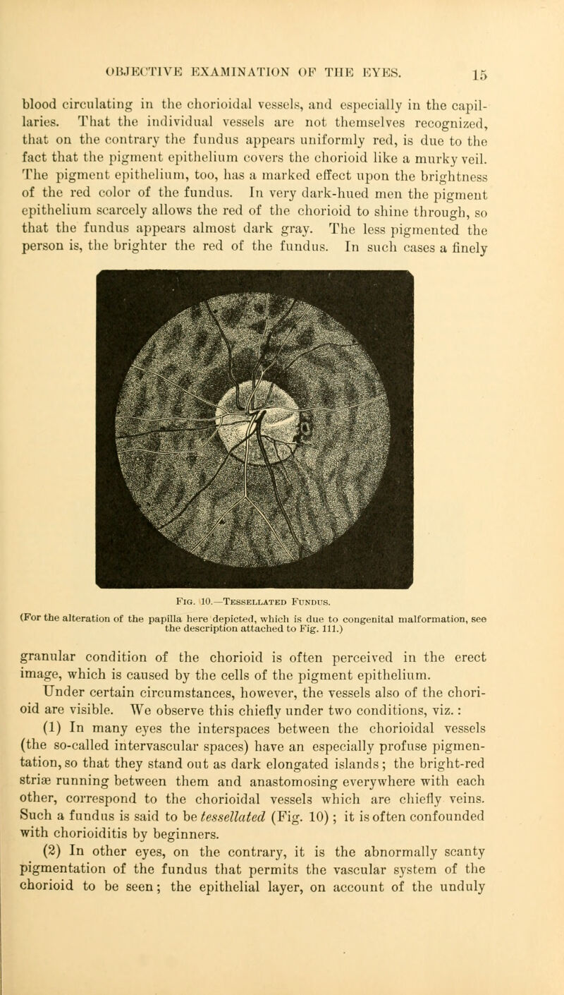 blood circulating in the chorioidal vessels, and especially in the capil- laries. That the individual vessels are not themselves recognized, that on the contrary the fundus appears uniformly red, is due to the fact that the pigment epithelium covers the chorioid like a murky veil. The pigment epithelium, too, has a marked effect upon the brightness of the red color of the fundus. In very dark-hued men the pigment epithelium scarcely allows the red of the chorioid to shine through, so that the fundus appears almost dark gray. The less pigmented the person is, the brighter the red of the fundus. In such cases a finely Fig. 10.—Tessellated Fundus. (For the alteration of the papilla here depicted, which is due to congenital malformation, see the description attached to Fig. 111.) granular condition of the chorioid is often perceived in the erect image, which is caused by the cells of the pigment epithelium. Under certain circumstances, however, the vessels also of the chori- oid are visible. We observe this chiefly under two conditions, viz.: (1) In many eyes the interspaces between the chorioidal vessels (the so-called intervascular spaces) have an especially profuse pigmen- tation, so that they stand out as dark elongated islands; the bright-red striae running between them and anastomosing everywhere with each other, correspond to the chorioidal vessels which are chiefly veins. Such a fundus is said to be tessellated (Fig. 10); it is often confounded with chorioiditis by beginners. (2) In other eyes, on the contrary, it is the abnormally scanty pigmentation of the fundus that permits the vascular system of the chorioid to be seen; the epithelial layer, on account of the unduly