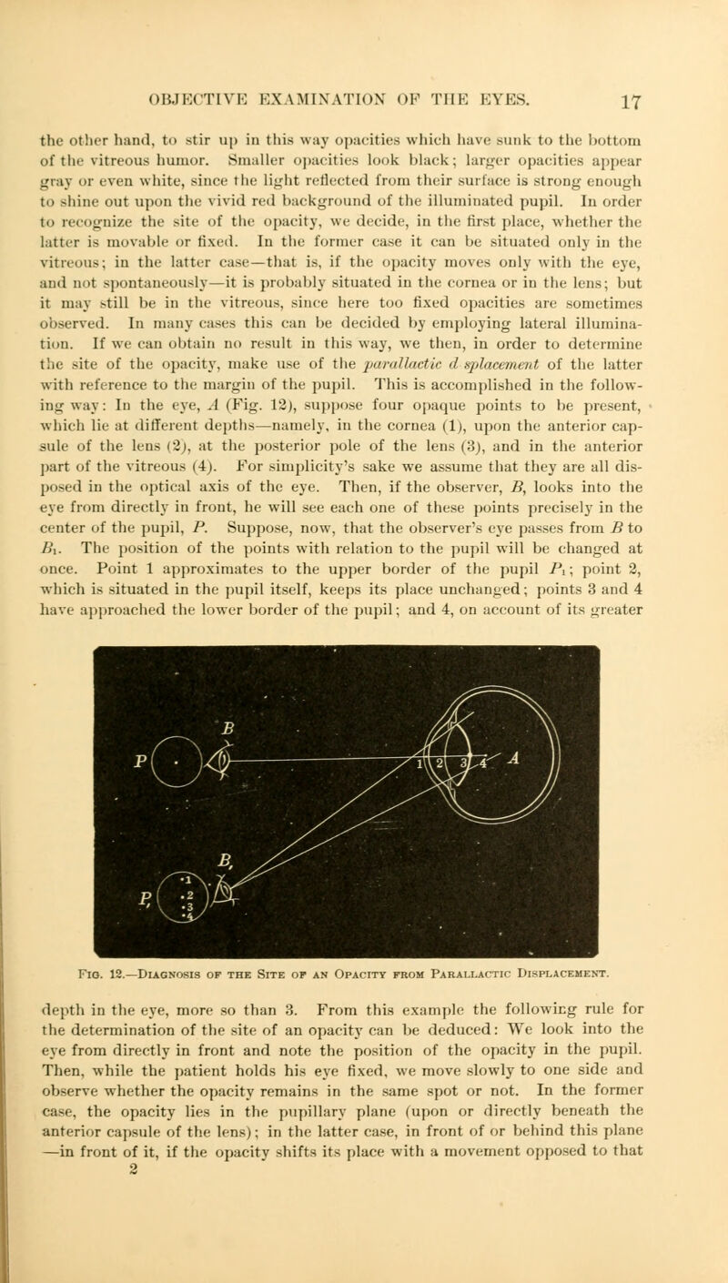 the other hand, to stir up in this way opacities which have sunk to the bottom of the vitreous humor. Smaller opacities look black; larger opacities appear gray or even white, since the light reflected from their surface is strong enough to >hine out upon the vivid red background of the illuminated pupil. In order to recognize the site of the opacity, we decide, in the first place, whether the latter i> movable or fixed. In the former case it can be situated only in the vitreous; in the latter case—that is, if the opacity moves only with the eye, and not spontaneously—it is probably situated in the cornea or in the lens; but it may still be in the vitreous, since here too fixed opacities are sometimes observed. In many cases this can be decided by employing lateral illumina- tion. If we can obtain no result in this way, we then, in order to determine the site of the opacity, make use of the parallactic d ^placement of the latter with reference to the margin of the pupil. This is accomplished in the follow- ing way: In the eye, A (Fig. 12), suppose four opaque points to be present, which lie at different depths—namely, in the cornea (1), upon the anterior cap- sule of the lens (2;, at the posterior pole of the lens (3), and in the anterior part of the vitreous (4). For simplicity's sake we assume that they are all dis- posed in the optical axis of the eye. Then, if the observer, B, looks into the eye from directly in front, he will see each one of these points precisely in the center of the pupil, P. Suppose, now, that the observer's eye passes from B to Z?i. The position of the points with relation to the pupil will be changed at once. Point 1 approximates to the upper border of the pupil Pi; point 2, which is situated in the pupil itself, keeps its place unchanged; points 3 and 4 have approached the lower border of the pupil; and 4, on account of its greater Fig. 12.—Diagnosis of the Site op an Opacity from Parallactic Displacement. depth in the eye, more so than 3. From this example the following rule for the determination of the site of an opacity can be deduced: We look into the eye from directly in front and note the position of the opacity in the pupil. Then, while the patient holds his eye fixed, we move slowly to one side and observe whether the opacity remains in the same spot or not. In the former case, the opacity lies in the pupillary plane (upon or directly beneath the anterior capsule of the lens); in the latter case, in front of or behind this plane —in front of it, if the opacity shifts its place with a movement opposed to that 2