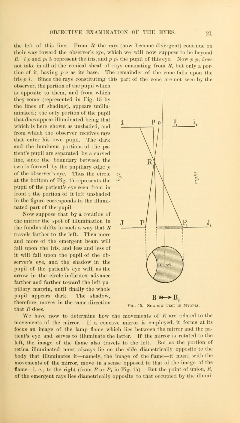 2] the left of this Hue. From R the rays (now become divergent) continue on their way toward the observer's eye, which we will now suppose to be beyond B. / p and p\ ii represent the iris, and p p, the pupil of this eye. Now p px does not take in all of the conical sheaf of rays emanating from R, but only a por- tion of it, having p o as its base. The remainder of the cone falls upon the iris p i. Since the rays constituting this part of the cone are not seen by the observer, the portion of the pupil which is opposite to them, and from which they come (represented in Fig. 15 by the lines of shading), appears unillu- minated ; the only portion of the pupil that does appear illuminated being that which is here shown as unshaded, and from which the observer receives rays that enter his own pupil. The dark and the luminous portions of the pa- tient's pupil are separated by a curved line, since the boundary between the two is formed by the pupillary edge p of the observer's eye. Thus the circle at the bottom of Fig. 15 represents the pupil of the patient's eye seen from in front ; the portion of it left unshaded in the figure corresponds to the illumi- nated part of the pupil. Now suppose that by a rotation of the mirror the spot of illumination in the fundus shifts in such a way that R travels farther to the left. Then more and more of the emergent beam will fall upon the iris, and less and less of it will fall upon the pupil of the ob- server's eye, and the shadow in the pupil of the patient's eye will, as the arrow in the circle indicates, advance farther and farther toward the left pu- pillary margin, until finally the whole pupil appears dark. The shadow, therefore, moves in the same direction that R does. We have now to determine how the movements of R are related to the movements of the mirror. If a concave mirror is employed, it forms at its focus an image of the lamp flame which lies between the mirror and the pa- tient's eye and serves to illuminate the latter. If the mirror is rotated to the left, the image of the flame also travels to the left. But as the portion of retina illuminated must always lie on the side diametrically opposite to the body that illuminates it—namely, the image of the flame—it must, with the movements of the mirror, move in a sense opposed to that of the image of the flame—i. e., to the right (from B or Pi in Fig. 15). But the point of union, R, of the emergent rays lies diametrically opposite to that occupied by the illumi- B>»-->B