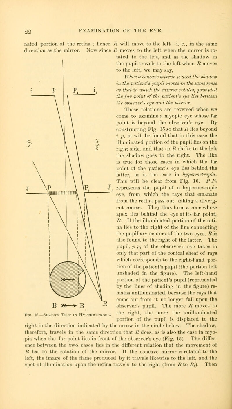 nated portion of the retina ; hence R will move to the left—i. e., in the same direction as the mirror. Now since A' moves to the left when the mirror is ro- tated to the left, and as the shadow in the pupil travels to the left when R moves to the left, we may say, When a concave mirror is used the shadow in the patient's pupil moves in the same sense as that in which the mirror rotates, provided the far point of the patient's eye lies between the observer's eye and the mirror. These relations are reversed when we come to examine a myopic eye whose far point is beyond the observer's eye. By constructing Kig. 15 so that R lies beyond i p, it will be found that in this case the illuminated portion of the pupil lies on the right side, and that as R shifts to the left the shadow goes to the right. The like is true for those cases in which the far point of the patient's eye lies behind the latter, as is the case in hypermetropic. This will be clear from Kig. 16. PP, represents the pupil of a hypermetropic eye, from which the rays that emanate from the retina pass out, taking a diverg- ent course. They thus form a cone whose apex lies behind the eye at its far point, R. If the illuminated portion of the reti- na lies to the right of the line connecting the pupillary centers of the two eyes, R is also found to the right of the latter. The pupil, p pi of the observer's eye takes in only that part of the conical sheaf of rays which corresponds to the right-hand por- tion of the patient's pupil (the portion left unshaded in the figure). The left-hand portion of the patient's pupil (represented by the lines of shading in the figure) re- mains unilluminated, because the rays that come out from it no longer fall upon the observer's pupil. The more R moves to the right, the more the unilluminated portion of the pupil is displaced to the right in the direction indicated by the arrow in the circle below. The shadow, therefore, travels in the same direction that R does, as is also the case in myo- pia when the far point lies in front of the observer's eye (Kig. 15). The differ- ence between the two cases lies in the different relation that the movement of R has to the rotation of the mirror. If the concave mirror is rotated to the left, the image of the flame produced by it travels likewise to the left, and the spot of illumination upon the retina travels to the right (from B to Bx). Then