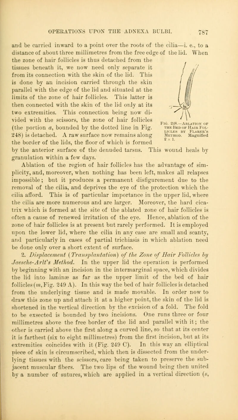 and be carried inward to a point over the roots of the cilia—i. e., to a distance of about three millimetres from the free edge of the lid. When the zone of hair follicles is thus detached from the tissues beneath it, we now need only separate it from its connection with the skin of the lid. This is done by an incision carried through the skin parallel with the edge of the lid and situated at the limits of the zone of hair follicles. This latter is then connected with the skin of the lid only at its two extremities. This connection being now di- vided with the scissors, the zone of hair follicles Fig. 24*.—Ablation of (the portion a, bounded bv the dotted line in Fig. theBedofHairFol- . , . , ,  , i LICLES BY FLARER'S 248) is detached. A raw surface now remains along method. Magnified the border of the lids, the floor of which is formed by the anterior surface of the denuded tarsus. This wound heals by granulation within a few days. Ablation of the region of hair follicles has the advantage of sim- plicity, and, moreover, when nothing has been left, makes all relapses impossible; but it produces a permanent disfigurement due to the removal of the cilia, and deprives the eye of the protection which the cilia afford. This is of particular importance in the upper lid, where the cilia are more numerous and are larger. Moreover, the hard cica- trix which is formed at the site of the ablated zone of hair follicles is often a cause of renewed irritation of the eye. Hence, ablation of the zone of hair follicles is at present but rarely performed. It is employed upon the lower lid, where the cilia in any case are small and scanty, and particularly in cases of partial trichiasis in which ablation need be done only over a short extent of surface. 2. Displacement {Transplantation) of the Zone of Hair Follicles by J/iesrJie-Arlfs Method. In the upper lid the operation is performed by beginning with an incision in the intermarginal space, which divides the lid into laminae as far as the upper limit of the bed of hair follicles (w,Fig. 249 A). In this way the bed of hair follicles is detached from the underlying tissue and is made movable. In order now to draw this zone up and attach it at a higher point, the skin of the lid is shortened in the vertical direction by the excision of a fold. The fold to be exsected is bounded by two incisions. One runs three or four millimetres above the free border of the lid and parallel with it; the other is carried above the first along a curved line, so that at its center it is farthest (six to eight millimetres) from the first incision, but at its extremities coincides with it (Fig. 249 0). In this way an elliptical piece of skin is circumscribed, which then is dissected from the under- lying tissues with the scissors, care being taken to preserve the sub- jacent muscular fibers. The two lips of the wound being then united by a number of sutures, which are applied in a vertical direction (s,