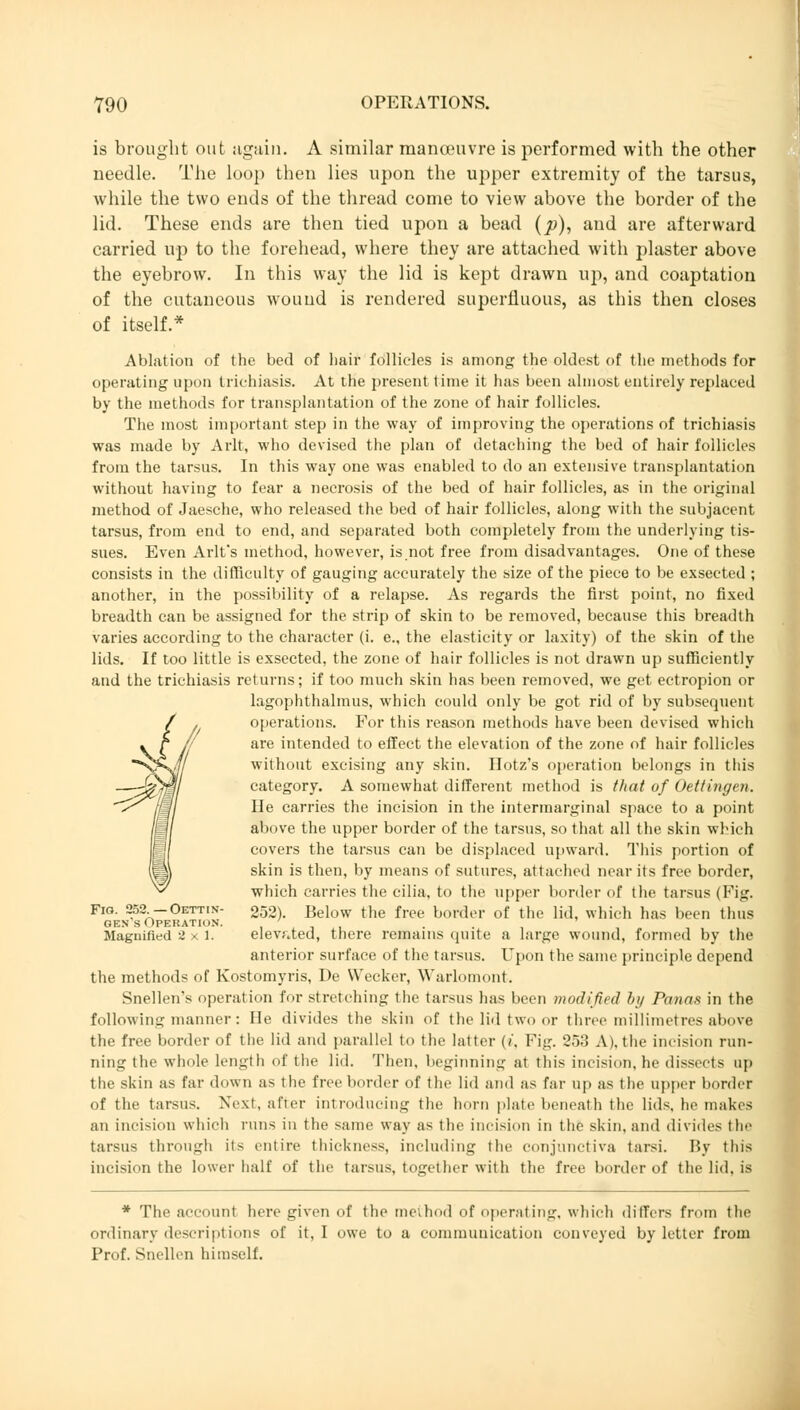 is brought out again. A similar manoeuvre is performed with the other needle. The loop then lies upon the upper extremity of the tarsus, while the two ends of the thread come to view above the border of the lid. These ends are then tied upon a bead (p), and are afterward carried up to the forehead, where they are attached with plaster above the eyebrow. In this way the lid is kept drawn up, and coaptation of the cutaneous wound is rendered superfluous, as this then closes of itself.* Ablation of the bed of hair follicles is among the oldest of the methods for operating upon trichiasis. At the present time it has been almost entirely replaced by the methods for transplantation of the zone of hair follicles. The most important step in the way of improving the operations of trichiasis was made by Arlt, who devised the plan of detaching the bed of hair follicles from the tarsus. In this way one was enabled to do an extensive transplantation without having to fear a necrosis of the bed of hair follicles, as in the original method of Jaesche, who released the bed of hair follicles, along with the subjacent tarsus, from end to end, and separated both completely from the underlying tis- sues. Even Arlt's method, however, is.not free from disadvantages. One of these consists in the difficulty of gauging accurately the size of the piece to be exsecti <1 ; another, in the possibility of a relapse. As regards the first point, no fixed breadth can be assigned for the strip of skin to be removed, because this breadth varies according to the character (i. e., the elasticity or laxity) of the skin of the lids. If too little is exsected, the zone of hair follicles is not drawn up sufficiently and the trichiasis returns; if too much skin has been removed, we get ectropion or lagophthalmus, which could only be got rid of by subsequent operations. For this reason methods have been devised which are intended to effect the elevation of the zone of hair follicles without excising any skin. Ilotz's operation belongs in tins category. A somewhat different method is that of Oettingen. J^/Jl/ He carries the incision in the intermarginal space to a point above the upper border of the tarsus, so that all the skin which covers the tarsus can be displaced upward. This portion of skin is then, by means of sutures, attached near its free border, which carries the cilia, to the upper border of the tarsus (Fig. Fig. 252 -Oett.n- 252). Below the free border of the lid, which has been thus gens Operation. ' Magnified 2x1. elevated, there remains quite a large wound, formed by the anterior surface of the tarsus. Upon the same principle depend the methods of Kostomyris, De Wecker, Warlomont Snellen's operation for stretching the tarsus has been modified by Panas in the following manner : He divides the skin of the lid two or three millimetres above the free border of the lid and parallel to the latter (t, Fig. 253 A),the incision run- ning the whole length of the lid. Then, beginning at this incision, he dissrrt> up the skin as far down as the free border of the lid and as far up as the upper bonier of the tarsus. Next, after introducing the horn plate beneath the lids, he makes an incision which runs in the same way as the incision in the skin, and divides the tarsus through its entire thickness, including the conjunctiva tarsi. By this incision the lower half of the tarsus, together with the free border of the lid, is * The account here given of the meihod of operating, which differs from the ordinary descriptions of it, I owe to a communication conveyed by letter from Prof. Snellen himself.