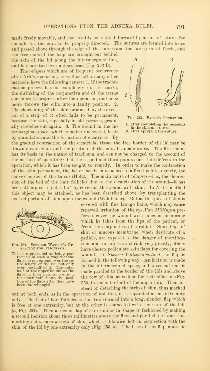 Fig. 253.—Panas's Operation. A. after completing the incisions in the skin and tarsus. B, after applying the suture. made freely movable, and can readily be rotated forward by means of sutures far enough for the cilia to be properly directed. The sutures are formed into loops and passed above through the edge of the tarsus and the tarso-orbital fascia, and the free ends of the loop are brought out behind the skin of the lid along the intermarginal line, and here are tied over a glass bead (Fig. 253 B). The relapses which are of frequent occurrence after Arlt's operation, as well as after many other methods, have the following causes: 1. If the tracho- matous process has not completely run its course, the shrinking of the conjunctiva and of the tarsus continues to progress after the operation, and once more throws the cilia into a faulty position. 2. The shortening of the skin produced by the excis- ion of a strip of it often fails to be permanent, because the skin, especially in old persons, gradu- ally stretches out again. 3. The wound in the in- termarginal space, which remains uncovered, heals by granulation and the formation of cicatrices. By the gradual contraction of the cicatricial tissue the free border of the lid may be drawn down again and the position of the cilia be made worse. The first point has its basis in the nature of trachoma, and can not be charged to the account of the method of operating; but the second and third points constitute defects in the operation, which it has been sought to remedy. In order to make the contraction of the skin permanent, the latter has been attached to a fixed point—namely, the convex border of the tarsus (Hotz). The main cause of relapses—i. e., the depres- sion of the bed of the hair follicles due to the cicatrization of the wound—it has been attempted to get rid of by covering the wound with skin. In Arlt's method this object may be attained, as has been described above, by transplanting the excised portion of skin upon the wound (Waldhauer). But as this piece of skin is covered with fine lanugo hairs, which may cause renewed irritation of the eye, Van Millingen pre- fers to cover the wound with mucous membrane which he takes from the lips of the patient, or from the conjunctiva of a rabbit. Since flaps of skin or mucous membrane, when destitute of a pedicle, are exposed to the danger of mortifica- tion, and in any case shrink very greatly, others have chosen pediculate skin flaps for covering the wound. In Spencer Watson's method this flap is formed in the following way : An incision is made in the intermarginal space, and a second one is made parallel to the border of the lids and above the row of cilia, as is done for their ablation (Fig. 254, in ihe outer half of the upper lid). Then, in- stead of detaching the strip of skin, thus marked out, at both ends, as in the operation of ablation, it is separated at one extremity only. The bed of hair follicles is thus transformed into a long, slender flap which is free at one extremity, but at the other is connected with the skin of the lids (a, Fig. 254). Then a second flap of skin similar in shape is fashioned by making a second incision about three millimetres above the first and parallel to it, and thus marking out a narrow strip of skin, which is likewise left in connection with the skin of the lid by one extremity only (Fig. 253, b). The base of this flap must lie Fig. 254.—Spencer Watson's Op- ekation for trichiasis. This is represented as being per- formed in such a way that the flaps do not extend over the en- tire length of the lid. but only over one half of it. The outer half of the upper lid shows the flaps in their natural position; the inner half shows the posi- tion of the flaps after they have been interchanged.