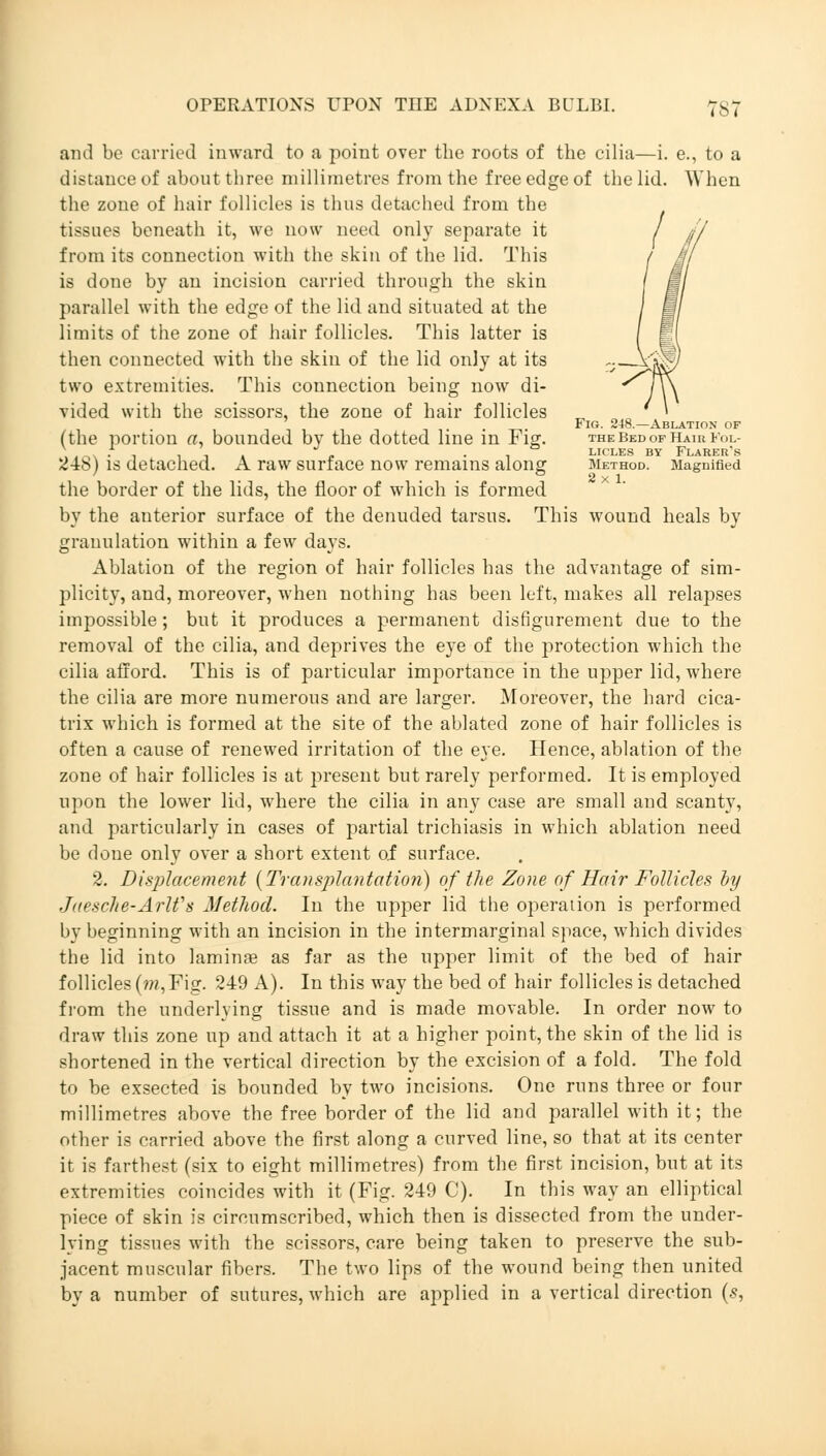ami be carried inward to a point over the roots of the cilia—i. e., to a distance of about three millimetres from the free edge of the lid. When the zone of hair follicles is thus detached from the tissues beneath it, we now need only separate it from its connection with the skin of the lid. This is done by an incision carried through the skin parallel with the edge of the lid and situated at the limits of the zone of hair follicles. This latter is then connected with the skin of the lid only at its two extremities. This connection being now di- vided with the scissors, the zone of hair follicles Fig. 248.—Ablation of (the portion a, bounded by the dotted line in Fig. theBedofHairFol- :._»., it» P • i LICLES BY FlARER's 24s is detached. A raw surface now remains along method. Magnified . . 2x1 the border of the lids, the floor of which is formed by the anterior surface of the denuded tarsus. This wound heals by granulation within a few days. Ablation of the region of hair follicles has the advantage of sim- plicity, and, moreover, when nothing has been left, makes all relapses impossible; but it produces a permanent disfigurement due to the removal of the cilia, and deprives the eye of the protection which the cilia afford. This is of particular importance in the upper lid, where the cilia are more numerous and are larger. Moreover, the hard cica- trix which is formed at the site of the ablated zone of hair follicles is often a cause of renewed irritation of the eye. Hence, ablation of the zone of hair follicles is at present but rarely performed. It is employed upon the lower lid, where the cilia in any case are small and scanty, and particularly in cases of partial trichiasis in which ablation need be done only over a short extent of surface. 2. Displacement {Transplantation) of the Zone of Hair Follicles by Jaesche-ArWs Method. In the upper lid the operation is performed by beginning with an incision in the intermarginal space, which divides the lid into laminae as far as the upper limit of the bed of hair follicles (w, Fig. 249 A). In this way the bed of hair follicles is detached from the underlying tissue and is made movable. In order now to draw this zone up and attach it at a higher point, the skin of the lid is shortened in the vertical direction by the excision of a fold. The fold to be exsected is bounded by two incisions. One runs three or four millimetres above the free border of the lid and parallel with it; the other is carried above the first along a curved line, so that at its center it is farthest (six to eight millimetres) from the first incision, but at its extremities coincides with it (Fig. 249 C). In this way an elliptical piece of skin is circumscribed, which then is dissected from the under- lying tissues with the scissors, care being taken to preserve the sub- jacent muscular fibers. The two lips of the wound being then united by a number of sutures, which are applied in a vertical direction (s,