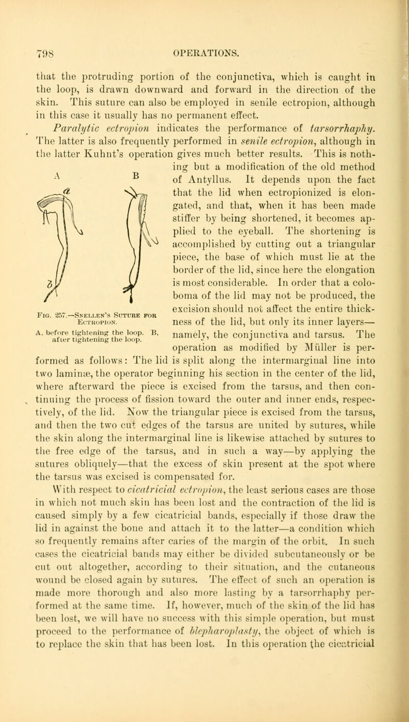 Fig. 257.—Snellen's Suture for Ectropion. A, before tightening the loop. B, after tightening the loop. that the protruding portion of the conjunctiva, which is caught in the loop, is drawn downward and forward in the direction of the skin. This suture can also be employed in senile ectropion, although in this case it usually has no permanent effect. Paralytic ectropion indicates the performance of tarsorrhaphy. The latter is also frequently performed in senile ectropion, although in the latter Kuhnt's operation gives much better results. This is noth- ing but a modification of the old method of Antyllus. It depends upon the fact that the lid when ectropionized is elon- gated, and that, when it has been made stiffer by being shortened, it becomes ap- plied to the eyeball. The shortening is accomplished by cutting out a triangular piece, the base of which must lie at the border of the lid, since here the elongation is most considerable. In order that a colo- boma of the lid may not be produced, the excision should not affect the entire thick- ness of the lid, but only its inner layers— namely, the conjunctiva and tarsus. The operation as modified by Müller is per- formed as follows: The lid is split along the intermarginal line into two laminae, the operator beginning his section in the center of the lid, where afterward the piece is excised from the tarsus, and then con- tinuing the process of fission toward the outer and inner ends, respec- tively, of the lid. Now the triangular piece is excised from the tarsus, and then the two cut edges of the tarsus are united by sutures, while the skin along the intermarginal line is likewise attached by sutures to the free edge of the tarsus, and in such a way—by applying the sutures obliquely—that the excess of skin present at the spot where the tarsus was excised is compensated for. With respect to cicatricial ectropion, the least serious cases are those in which not much skin has been lost and the contraction of the lid is caused simply by a few cicatricial bands, especially if those draw the lid in against the bone and attach it to the latter—a condition which so frequently remains after caries of the margin of the orbit. In such cases the cicatricial bands may either be divided subcutaneously or be cut out altogether, according to their situation, and the cutaneous wound be closed again by sutures. The effect of such an operation is made more thorough and also more lasting by a tarsorrhaphy per- formed at the same time. If, however, much of the skin of the lid has been lost, we will have no success with this simple operation, but must proceed to the performance of blcpharoplasty, the object of which is to replace the skin that has been lost. In this operation the cicatricial