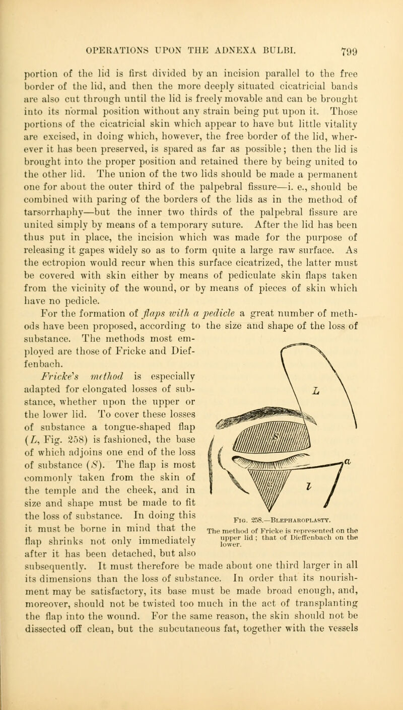 portion of the lid is first divided by an incision parallel to the free border of the lid, and then the more deeply situated cicatricial bands are also cut through until the lid is freely movable and can be brought into its normal position without any strain being put upon it. Those portions of the cicatricial skin which appear to have but little vitality are excised, in doing which, however, the free border of the lid, wher- ever it has been preserved, is spared as far as possible; then the lid is brought into the proper position and retained there by being united to the other lid. The union of the two lids should be made a permanent one for about the outer third of the palpebral fissure—i. e., should be combined with paring of the borders of the lids as in the method of tarsorrhaphy—but the inner two thirds of the palpebral fissure are united simply by means of a temporary suture. After the lid has been thus put in place, the incision which was made for the purpose of releasing it gapes widely so as to form quite a large raw surface. As the ectropion would recur when this surface cicatrized, the latter must be covered with skin either by means of pediculate skin flaps taken from the vicinity of the wound, or by means of pieces of skin which have no pedicle. For the formation of flaps with a pedicle a great number of meth- ods have been proposed, according to the size and shape of the loss of substance. The methods most em- ployed are those of Fricke and Dief- fenbach. Fricke^s nutJiod is especially adapted for elongated losses of sub- stance, whether upon the upper or the lower lid. To cover these losses of substance a tongue-shaped flap (L, Fig. 258) is fashioned, the base of which adjoins one end of the loss of substance (S). The flap is most commonly taken from the skin of the temple and the cheek, and in size and shape must be made to fit the loss of substance. In doing this it must be borne in mind that the flap shrinks not only immediately after it has been detached, but also subsequently. It must therefore be made about one third larger in all its dimensions than the loss of substance. In order that its nourish- ment may be satisfactory, its base must be made broad enough, and, moreover, should not be twisted too much in the act of transplanting the flap into the wound. For the same reason, the skin should not be dissected off clean, but the subcutaneous fat, together with the vessels Fig. 258.—Blepharoplasty. The method of Frieke is represented on the upper lid ; that of Dieffenbach on the lower.