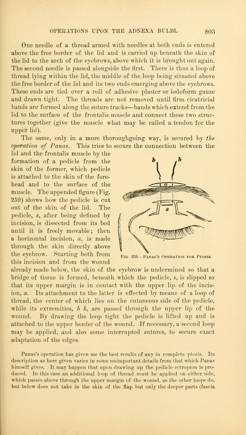 One needle of a thread armed with needles at both ends is entered above the free border of the lid and is carried up beneath the skin of the lid to the arch of the eyebrows, above which it is brought out again. The second needle is passed alongside the first. There is thus a loop of thread lying within the lid, the middle of the loop being situated above the free border of the lid and its two ends emerging above the eyebrows. These ends are tied over a roll of adhesive plaster or iodoform gauze and drawn tight. The threads are not removed until firm cicatricial bands are formed along the suture tracks—bands which extend from the lid to the surface of the frontalis muscle and connect these two struc- tures together (give the muscle what may be called a tendon for the upper lid). The same, only in a more thoroughgoing way, is secured by the operation of Panas. This tries to secure the connection between the lid and the frontalis muscle by the formation of a pedicle from the skin of the former, which pedicle is attached to the skin of the fore- head and to the surface of the muscle. The appended figure (Fig. 259) shows how the pedicle is cut out of the skin of the lid. The pedicle, s, after being defined by incision, is dissected from its bed until it is freely movable; then a horizontal incision, a, is made through the skin directly above the eyebrow. Starting both from this incision and from the wound already made below, the skin of the eyebrow is undermined so that a bridge of tissue is formed, beneath which the pedicle, s, is slipped so that its upper margin is in contact with the upper lip of the incis- ion, a. Its attachment to the latter is effected by means of a loop of thread, the center of which lies on the cutaneous side of the pedicle, while its extremities, b b, are passed through the upper lip of the wound. By drawing the loop tight the pedicle is lifted up and is attached to the upper border of the wound. If necessary, a second loop may be applied, and also some interrupted sutures, to secure exact adaptation of the edges. Fig. 259.—Panas's Operation for Ptosis. Panas's operation has given me the best results of any in complete ptosis. Its description as here given varies in some unimportant details from that which Panas himself gives. It may happen that upon drawing up the pedicle ectropion is pro- duced. In this case an additional loop of thread must be applied on either side, which passes above through the upper margin of the wound, as the other loops do, but below does not take in the skin of the flap but only the deeper parts (fascia