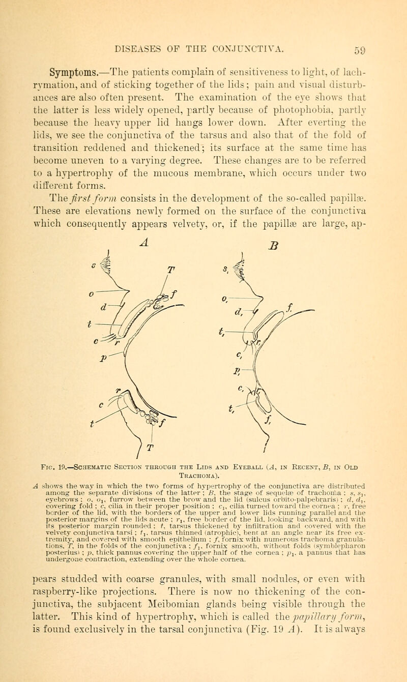 Symptoms.—The patients complain of sensitiveness to light, of lach- rvmation, and of sticking together of the lids; pain and visual disturb- ances are also often present. The examination of the eye shows that the latter is less widely opened, partly because of photophobia, partly because the heavy upper lid hangs lower down. After everting the lids, we see the conjunctiva of the tarsus and also that of the fold of transition reddened and thickened; its surface at the same time has become uneven to a varying degree. These changes are to be referred to a hypertrophy of the mucous membrane, which occurs under two different forms. The first form consists in the development of the so-called papillae. These are elevations newly formed on the surface of the conjunctiva which consequently appears velvety, or, if the papilla; are large, ap- A Fig. 19.—Schematic Section through the Lids and Eyeball (A, m Recent, B, in Old Trachoma). A shows the way in which the two forms of hypertrophy of the conjunctiva are distributed among the separate divisions of the latter; B. the stage of sequela? of trachoma : s, Sj, eyebrows : o. olt furrow between the brow and the lid (sulcus orbito-palpebrarisi ; d, d,, covering fold ; c, cilia in their proper position : C], cilia turned toward the cornea : r, free border of the lid, with the borders of the upper and lower lids running parallel and the posterior margins of the lids acute ; r,, free border of the lid. looking backward, and with its posterior margin rounded ; t. tarsus thickened by infiltration and covered with the velvety conjunctiva tarsi: /,. tarsus thinned (atrophic), bent at an angle near its free ex- tremity, and covered with smooth epithelium : /. fornix with numerous trachoma granula- tions, T, in the folds of the conjunctiva : f1. fornix smooth, without folds isymblepharon posteriusi ; p. thick pannus covering: the upper half of the cornea : pt, a pannus that has undergone contraction, extending over the whole cornea. pears studded with coarse granules, with small nodules, or even with raspberry-like projections. There is now no thickening of the con- junctiva, the subjacent Meibomian glands being visible through the latter. This kind of hypertrophy, which is called the papillary form, is found exclusively in the tarsal conjunctiva (Fig. 19 A). It is always