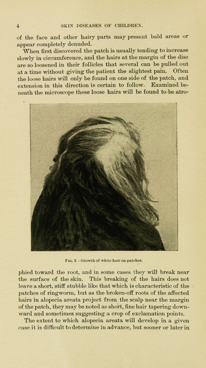of the face and other hairy parts may present hald areas or appear completely denuded. When first discovered the patch is usually tending to increase slowly in circumference, and the hairs at the margin of the disc are so loosened in their follicles that several can be pulled out at a time without giving the patient the slightest pain. Often the loose hairs will only he found on one side of the patch, and extension in this direction is certain to follow. Examined be- neath the microscope these loose hairs will be found to-be atro- Fig. 3-—Growth of white hair on patches. phied toward the root, and in some cases they will break near the surface of the skin. This breaking of the hairs does not leave a short, stiff stubble like that which is characteristic of the patches of ringworm, but as the broken-off roots of the affected hairs in alopecia areata project from the scalp near the margin of the patch, they may be noted as short, fine hair tapering down- ward and sometimes suggesting a crop of exclamation points. The extent to which alopecia areata will develop in a given case it is difficult to determine in advance, but sooner or later in