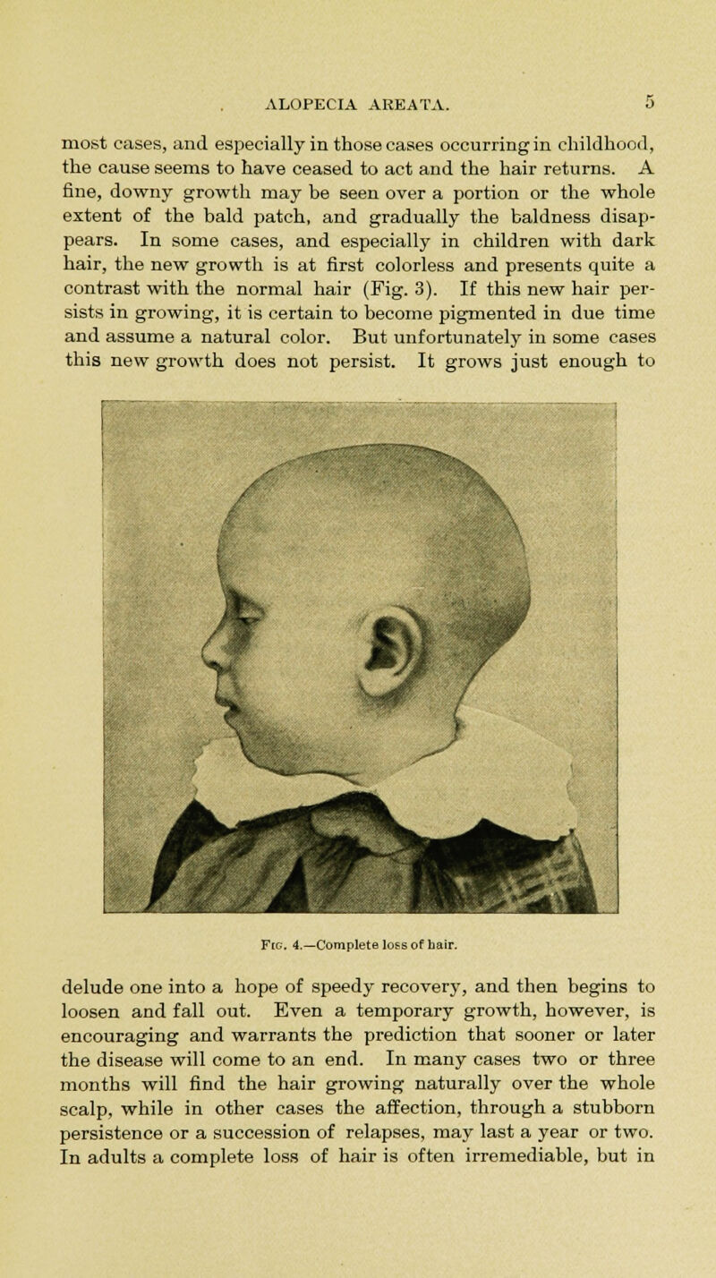 most cases, and especially in those cases occurring in childhood, the cause seems to have ceased to act and the hair returns. A fine, downy growth may he seen over a portion or the whole extent of the bald patch, and gradually the baldness disap- pears. In some cases, and especially in children with dark hair, the new growth is at first colorless and presents quite a contrast with the normal hair (Fig. 3). If this new hair per- sists in growing, it is certain to become pigmented in due time and assume a natural color. But unfortunately in some cases this new growth does not persist. It grows just enough to Fig. 4.—Complete loss of bair. delude one into a hope of speedy recovery, and then begins to loosen and fall out. Even a temporary growth, however, is encouraging and warrants the prediction that sooner or later the disease will come to an end. In many cases two or three months will find the hair growing naturally over the whole scalp, while in other cases the affection, through a stubborn persistence or a succession of relapses, may last a year or two. In adults a complete loss of hair is often irremediable, but in