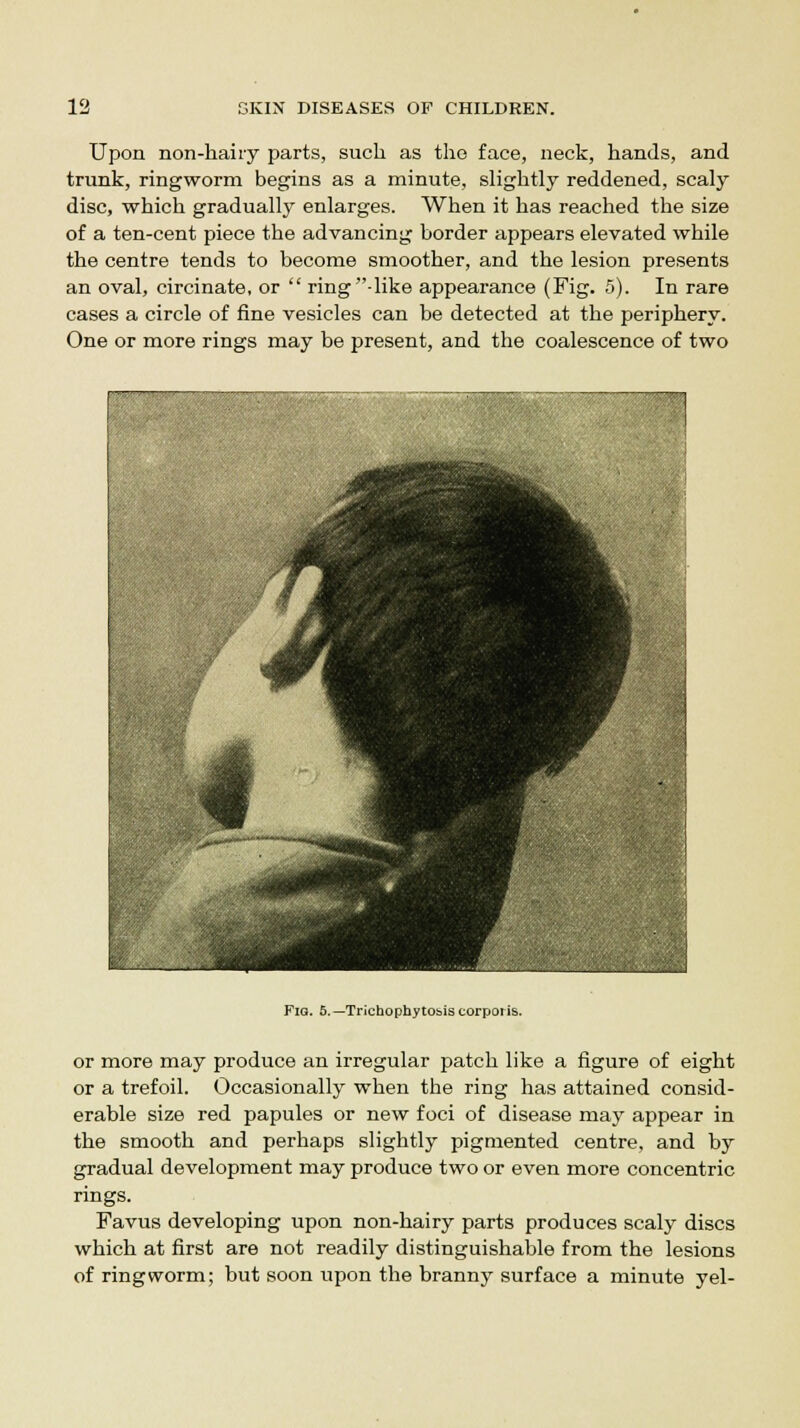 Upon non-hairy parts, such as tho face, neck, hands, and trunk, ringworm begins as a minute, slightly reddened, scaly disc, which gradually enlarges. When it has reached the size of a ten-cent piece the advancing border appears elevated while the centre tends to become smoother, and the lesion presents an oval, circinate, or  ring -like appearance (Fig. 5). In rare cases a circle of fine vesicles can be detected at the periphery. One or more rings may be present, and the coalescence of two ■ v^k ■ mm i: 4 tM .. . i Fig. 5.—TrichophytObis corporis. or more may produce an irregular patch like a figure of eight or a trefoil. Occasionally when the ring has attained consid- erable size red papules or new foci of disease may appear in the smooth and perhaps slightly pigmented centre, and by gradual development may produce two or even more concentric rings. Favus developing upon non-hairy parts produces scaly discs which at first are not readily distinguishable from the lesions of ringworm; but soon upon the branny surface a minute yel-