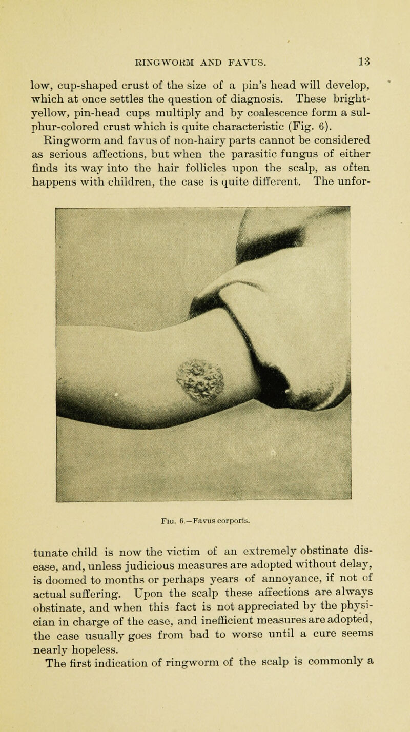 low, cup-shaped crust of the size of a pin's head will develop, which at once settles the question of diagnosis. These bright- yellow, pin-head cups multiply and by coalescence form a sul- phur-colored crust which is quite characteristic (Fig. 6). Ringworm and f avus of non-hairy parts cannot be considered as serious affections, but when the parasitic fungus of either finds its way into the hair follicles upon the scalp, as often happens with children, the case is quite different. The unfor- Fig. 6. —Favus corporis. tunate child is now the victim of an extremely obstinate dis- ease, and, unless judicious measures are adopted without delay, is doomed to months or perhaps years of annoyance, if not of actual suffering. Upon the scalp these affections are always obstinate, and when this fact is not appreciated by the physi- cian in charge of the case, and inefficient measures are adopted, the case usually goes from bad to worse until a cure seems nearly hopeless. The first indication of ringworm of the scalp is commonly a