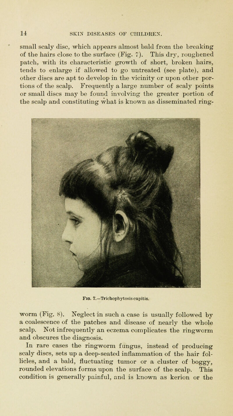 small scaly disc, which appears almost bald from the breaking of the hairs close to the surface (Fig. 7). This dry, roughened patch, with its characteristic growth of short, broken hairs, tends to enlarge if allowed to go untreated (see plate), and other discs are apt to develop in the vicinity or upon other por- tions of the scalp. Frequently a large number of scaly points or small discs may be found involving the greater portion of the scalp and constituting what is known as disseminated ring- MM ■ *%,--' W^^^Kr^~' M ,l|lL '} ^H -v ■ ^JX ll |f- ._ _j& Fio. 7.—Trichophytosis capitis. worm (Fig. 8). Neglect in such a case is usually followed by a coalescence of the patches and disease of nearly the whole scalp. Not infrequently an eczema complicates the ringworm and obscures the diagnosis. In rare cases the ringworm fungus, instead of producing scaly discs, sets up a deep-seated inflammation of the hair fol- licles, and a bald, fluctuating tumor or a cluster of boggy, rounded elevations forms upon the surface of the scalp. This condition is generally painful, and is known as kerion or the