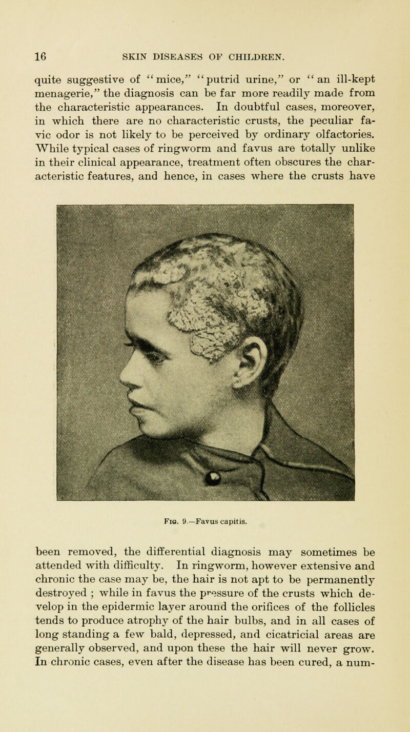 quite suggestive of mice, putrid urine, or an ill-kept menagerie, the diagnosis can be far more readily made from the characteristic appearances. In doubtful cases, moreover, in which there are no characteristic crusts, the peculiar fa- vic odor is not likely to be perceived by ordinary olfactories. While typical cases of ringworm and favus are totally unlike in their clinical appearance, treatment often obscures the char- acteristic features, and hence, in cases where the crusts have Fiq. 9.—Favus capitis. been removed, the differential diagnosis may sometimes be attended with difficulty. In ringworm, however extensive and chronic the case may be, the hair is not apt to be permanently destroyed ; while in favus the pressure of the crusts which de- velop in the epidermic layer around the orifices of the follicles tends to produce atrophy of the hair bulbs, and in all cases of long standing a few bald, depressed, and cicatricial areas are generally observed, and upon these the hair will never grow. In chronic cases, even after the disease has been cured, a num-