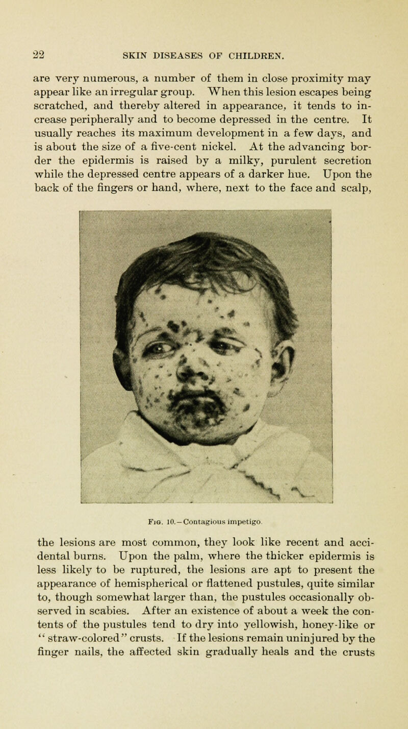 are very numerous, a number of them in close proximity may appear like an irregular group. When this lesion escapes being scratched, and thereby altered in appearance, it tends to in- crease peripherally and to become depressed in the centre. It usually reaches its maximum development in a few days, and is about the size of a five-cent nickel. At the advancing bor- der the epidermis is raised by a milky, purulent secretion while the depressed centre appears of a darker hue. Upon the back of the fingers or hand, where, next to the face and scalp, FiG. 10. —Contagious impetigo. the lesions are most common, they look like recent and acci- dental burns. Upon the palm, where the thicker epidermis is less likely to be ruptured, the lesions are apt to present the appearance of hemispherical or flattened pustules, quite similar to, though somewhat larger than, the pustules occasionally ob- served in scabies. After an existence of about a week the con- tents of the pustules tend to dry into yellowish, honey-like or  straw-colored crusts. If the lesions remain uninjured by the finger nails, the affected skin gradually heals and the crusts