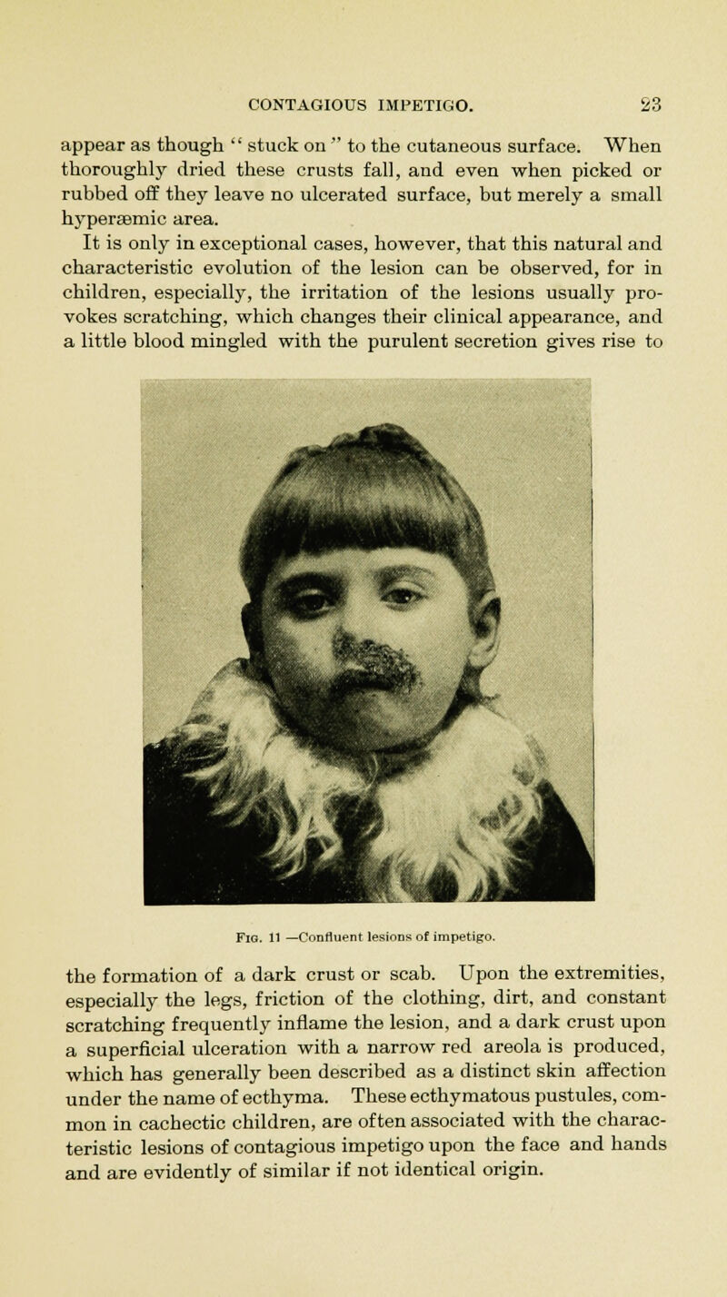 appear as though  stuck on  to the cutaneous surface. When thoroughly dried these crusts fall, and even when picked or rubbed off they leave no ulcerated surface, but merely a small hypera^mic area. It is only in exceptional cases, however, that this natural and characteristic evolution of the lesion can be observed, for in children, especially, the irritation of the lesions usually pro- vokes scratching, which changes their clinical appearance, and a little blood mingled with the purulent secretion gives rise to Fig. 11 —Confluent lesions of impetigo. the formation of a dark crust or scab. Upon the extremities, especially the legs, friction of the clothing, dirt, and constant scratching frequently inflame the lesion, and a dark crust upon a superficial ulceration with a narrow red areola is produced, which has generally been described as a distinct skin affection under the name of ecthyma. These ecthymatous pustules, com- mon in cachectic children, are often associated with the charac- teristic lesions of contagious impetigo upon the face and hands and are evidently of similar if not identical origin.