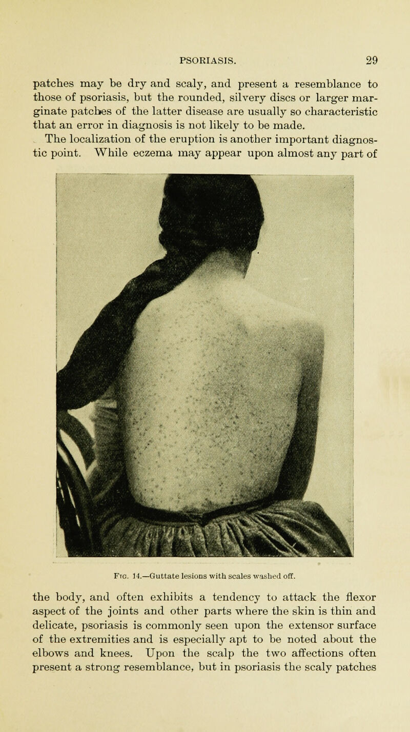 patches may be dry and scaly, and present a resemblance to those of psoriasis, but the rounded, silvery discs or larger mar- ginate patches of the latter disease are usually so characteristic that an error in diagnosis is not likely to be made. The localization of the eruption is another important diagnos- tic point. While eczema may appear upon almost any part of Fig. 14.—Guttate lesions with scales washed off. the body, and often exhibits a tendency to attack the flexor aspect of the joints and other parts where the skin is thin and delicate, psoriasis is commonly seen upon the extensor surface of the extremities and is especially apt to be noted about the elbows and knees. Upon the scalp the two affections often present a strong resemblance, but in psoriasis the scaly patches