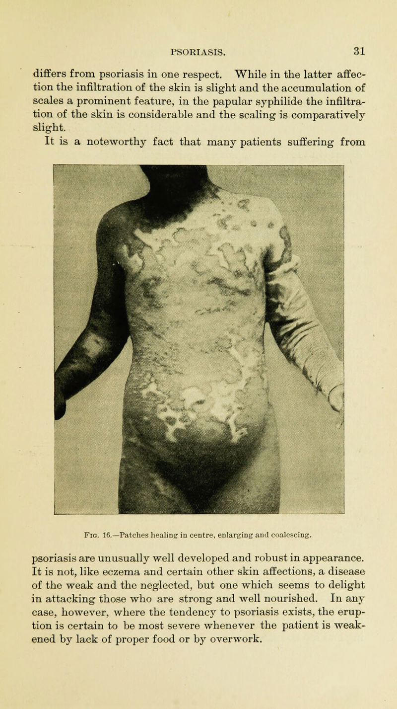 differs from psoriasis in one respect. While in the latter affec- tion the infiltration of the skin is slight and the accumulation of scales a prominent feature, in the papular syphilide the infiltra- tion of the skin is considerable and the scaling is comparatively slight. It is a noteworthy fact that many patients suffering from Fig. 16.—Patches healing in centre, enlarging and coalescing. psoriasis are unusually well developed and robust in appearance. It is not, like eczema and certain other skin affections, a disease of the weak and the neglected, but one which seems to delight in attacking those who are strong and well nourished. In any case, however, where the tendency to psoriasis exists, the erup- tion is certain to be most severe whenever the patient is weak- ened by lack of proper food or by overwork.