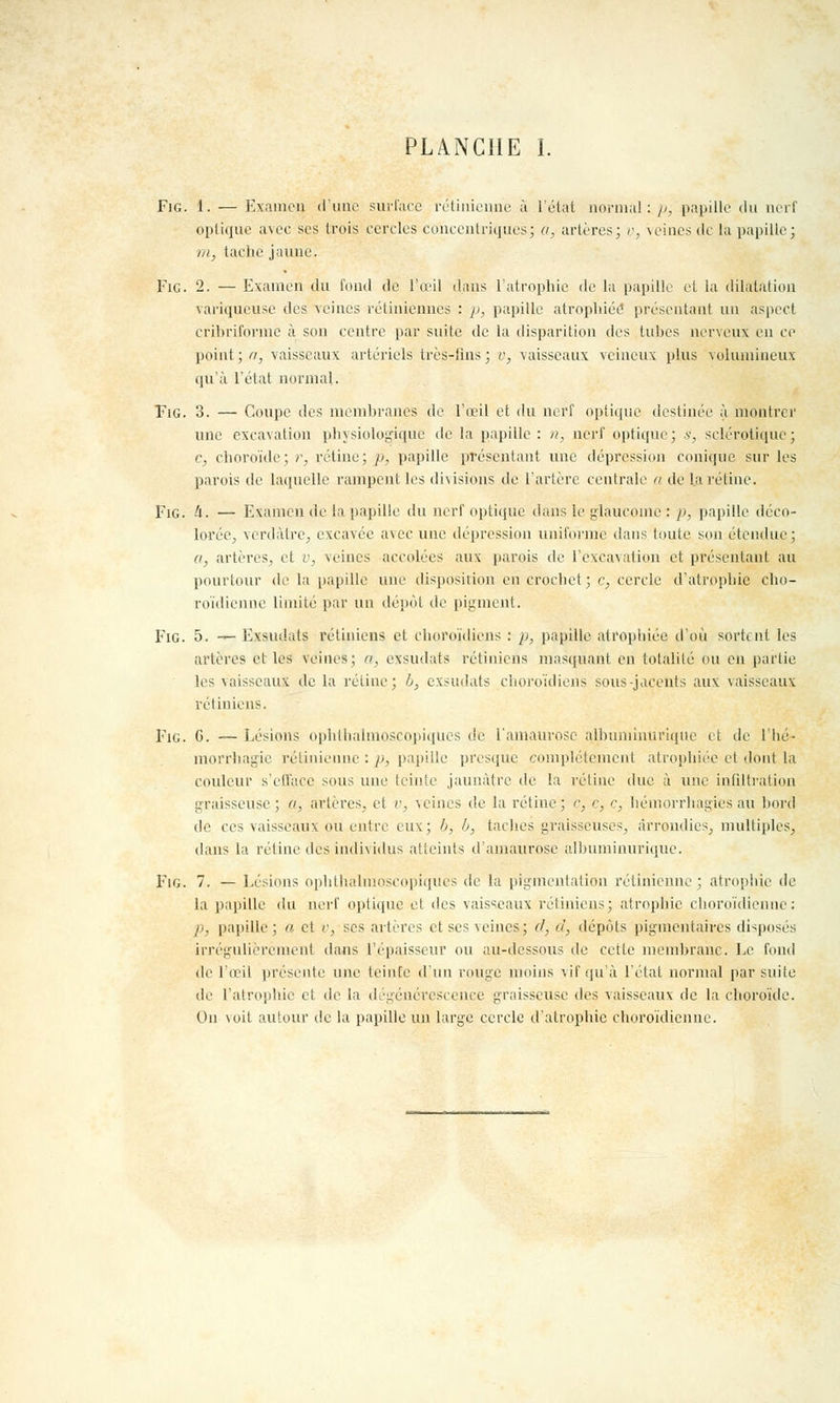 Fig. 1. — Examen d'une surface rétinienne à l'état normal : y, papille du nerf optique avec ses trois cercles concentriques; a, artères; v, veines de la papille; m, tache jaune. Fie. 2. — Examen du fond de l'œil dans l'atrophie de la papille et ia dilatation variqueuse des veines rétiniennes : y. papille atrophiée présentant un aspect cribriforme à son centre par suite de la disparition des tuhes nerveux en ce point; a, vaisseaux artériels très-lins; v, vaisseaux veineux plus volumineux qu'à l'état normal. Fig. 3. — Coupe des membranes de l'œil et du nerf optique destinée à montrer une excavation physiologique de la papille: n, nerf optique; s, sclérotique; c, choroïde; r, rétine; p, papille présentant une dépression conique sur les parois de laquelle rampent les divisions de l'artère centrale n de la rétine. Fig. à. — Examen de la papille du nerf optique dans le glaucome : », papille déco- lorée, verdàtre, excavée avec une dépression uniforme dans toute sou étendue; a, artères, et v, veines accolées aux parois de l'excavation et présentant au pourtour de la papille une disposition en crochet ; c, cercle d'atrophie cho- roïdienne limite par un dépôt de pigment. Fig. 5. — Exsudats rétiniens et choroïdiens : p, papille atrophiée d'où sortent les artères et les veines; a, exsudats rétiniens masquant en totalité ou en partie les vaisseaux de la rétine; h, exsudats choroïdiens sous-jaceîits aux vaisseaux rétiniens. Fig. G. — Lésions ophthalmoscopiqucs de l'amaurosc albuminuriquc et de l'hé- morrhagie rétinienne : p} papille presque complètement atrophiée et dont la couleur s'efface sous une teinte jaunâtre de la rétine duc à une infiltration graisseuse; a, artères, et v, veines de la rétine; c, c, c, hémorrhagies au bord de ces vaisseaux ou entre eux; h, b, taches graisseuses, arrondies, multiples, dans la rétine des individus atteints d'amaurose albuminuriquc. Fig. 7. — Lésions ophthalmoscopiqties de la pigmentation rétinienne; atrophie de la papille du nerf optique et des vaisseaux rétiniens; atrophie choroïdienne: p, papille ; a et v, ses artères et ses seines; d, d, dépôts pigmentaires disposés irrégulièrement dans l'épaisseur ou au-dessous de cette membrane. Le fond de l'œil présente une teinte d'un rouge moins vif qu'à l'état normal par suite de l'atrophie et de la dégénérescence graisseuse des vaisseaux de la choroïde. On voit autour de la papille un large cercle d'atrophie choroïdienne.