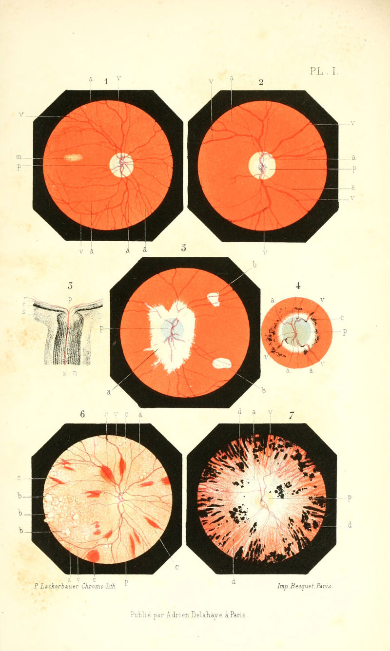 ? Lackerbauer Ckromo-Jith Imp Becquet, Pans