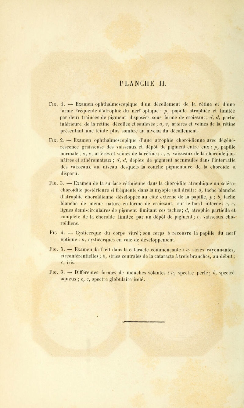 Fig. 1. — Examen ophthalmoscopique d'un décollement de la rétine et d'une forme fréquente d'atrophie du nerf optique : p, papille atrophiée et limitée par deux traînées de pigment disposées sous forme de croissant; d, cl, partie inférieure de la rétine décollée et soulevée ; a, v, artères et veines de la rétine présentant une teinte plus sombre au niveau du décollement. Fig. 2. — Examen ophthalmoscopique d'une atrophie choroïdienne avec dégéné- rescence graisseuse des vaisseaux et dépôt de pigment entre eux : p, papille normale ; a, v, artères et veines de la rétine ; c, e, vaisseaux de la choroïde jau- nâtres et atliéromateux ; d, cl, dépôts de pigment accumulés dans l'intervalle des vaisseaux au niveau desquels la couche pigmentaire de la choroïde a disparu. Fie. 3. — Examen de la surface rétinienne dans la choroïdite atrophique ou scléro- choroïdite postérieure si fréquente dans la myopie (œil droit) : a, tache blanche d'atrophie choroïdienne développée au côté externe de la papille, p ; b, tache blanche de même nature en forme de croissant, sur le bord interne; c, c, lignes demi-circulaires de pigment limitant ces taches; cl, atrophie partielle et complète de la choroïde limitée par un dépôt de pigment; r, vaisseaux cho- roïdiens. Fig. II. — Cysticcrque du corps vitré; son corps b recouvre la papille du nerf optique : a, cysticerques en voie de développement. Fig. 5. — Examen de l'œil dans la cataracte commençante : a, stries rayonnantes, circonférentielles ; b, stries centrales de la cataracte à trois branches, au début; c, iris. Fig. 0. — Différentes formes de mouches volantes : a, spectre perlé; b, spectre aqueux; c, c, spectre globulaire isolé.