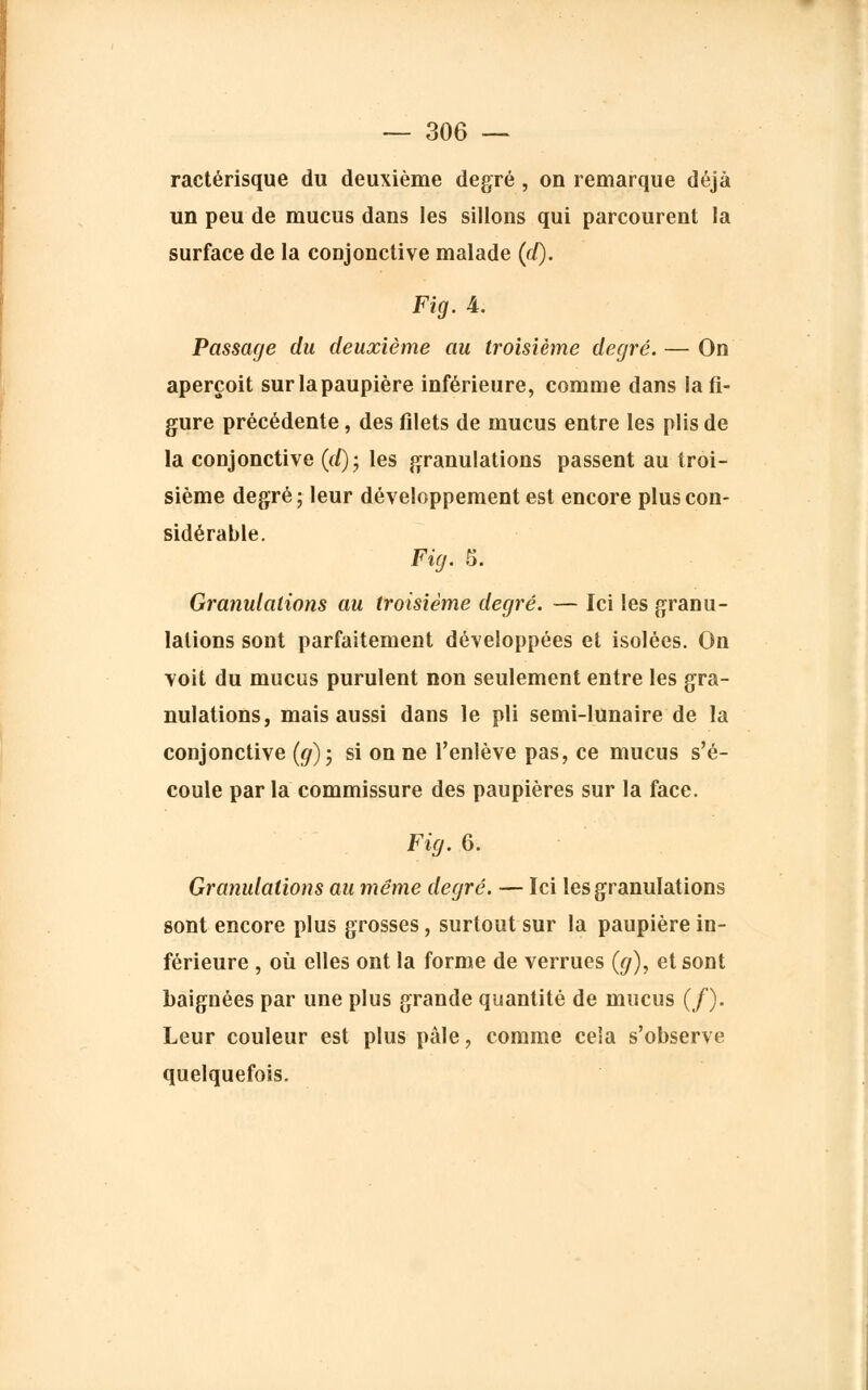 ractérisque du deuxième degré , on remarque déjà un peu de mucus dans les sillons qui parcourent la surface de la conjonctive malade (cQ. Fig. A. Passage du deuxième au troisième degré. — On aperçoit sur la paupière inférieure, comme dans la fi- gure précédente, des filets de mucus entre les plis de la conjonctive (d); les granulations passent au troi- sième degré; leur développement est encore plus con- sidérable. Fig. 6. Granulations au troisième degré. — Ici les granu- lations sont parfaitement développées et isolées. On voit du mucus purulent non seulement entre les gra- nulations, mais aussi dans le pli semi-lunaire de la conjonctive (g); si on ne l'enlève pas, ce mucus s'é- coule parla commissure des paupières sur la face. Fig. 6. Granulations au même degré. — Ici les granulations sont encore plus grosses, surtout sur la paupière in- férieure , où elles ont la forme de verrues (g), et sont baignées par une plus grande quantité de mucus (/). Leur couleur est plus pâle, comme cela s'observe quelquefois.