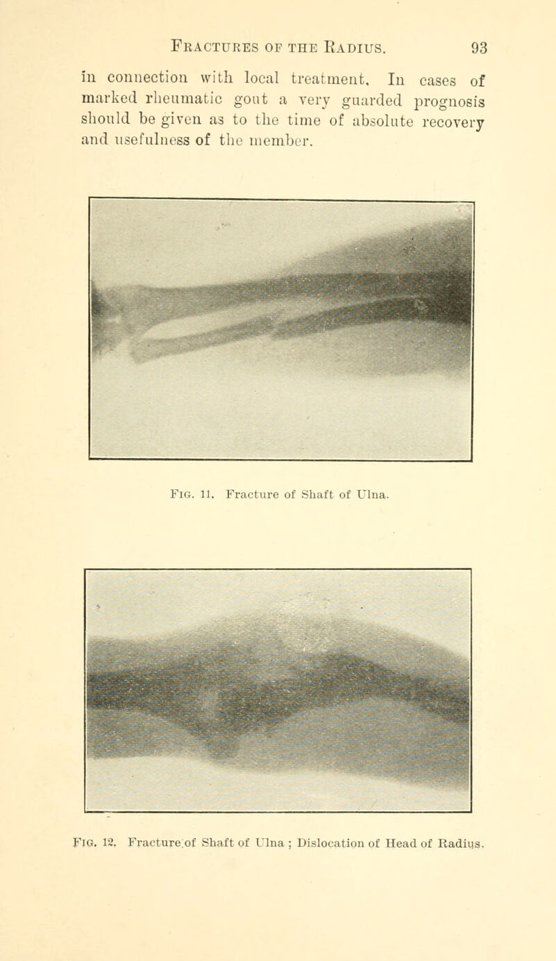 in connection with local treatment. In cases of marked rheumatic gout a very guarded prognosis should be given as to the time of absolute recovery and usefulness of the member. Fig. 11. Fracture of Shaft of Ulna. Fig. 12. Fracture;of Shaft of Ulna ; Dislocation of Head of Radius.